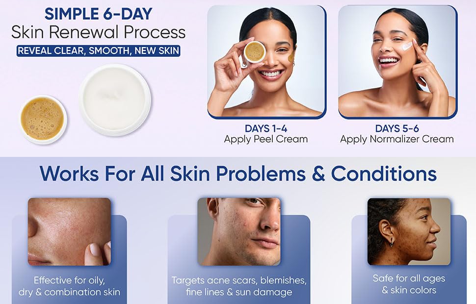 SKIN PEEL 4000 - Chemical Skin Peel Kit | Created in1937 | Gets rid of acne scars, blemishes, large pores, fine lines, sun damage in only 6 days! Beauty & Personal Care SKIN CULTURE