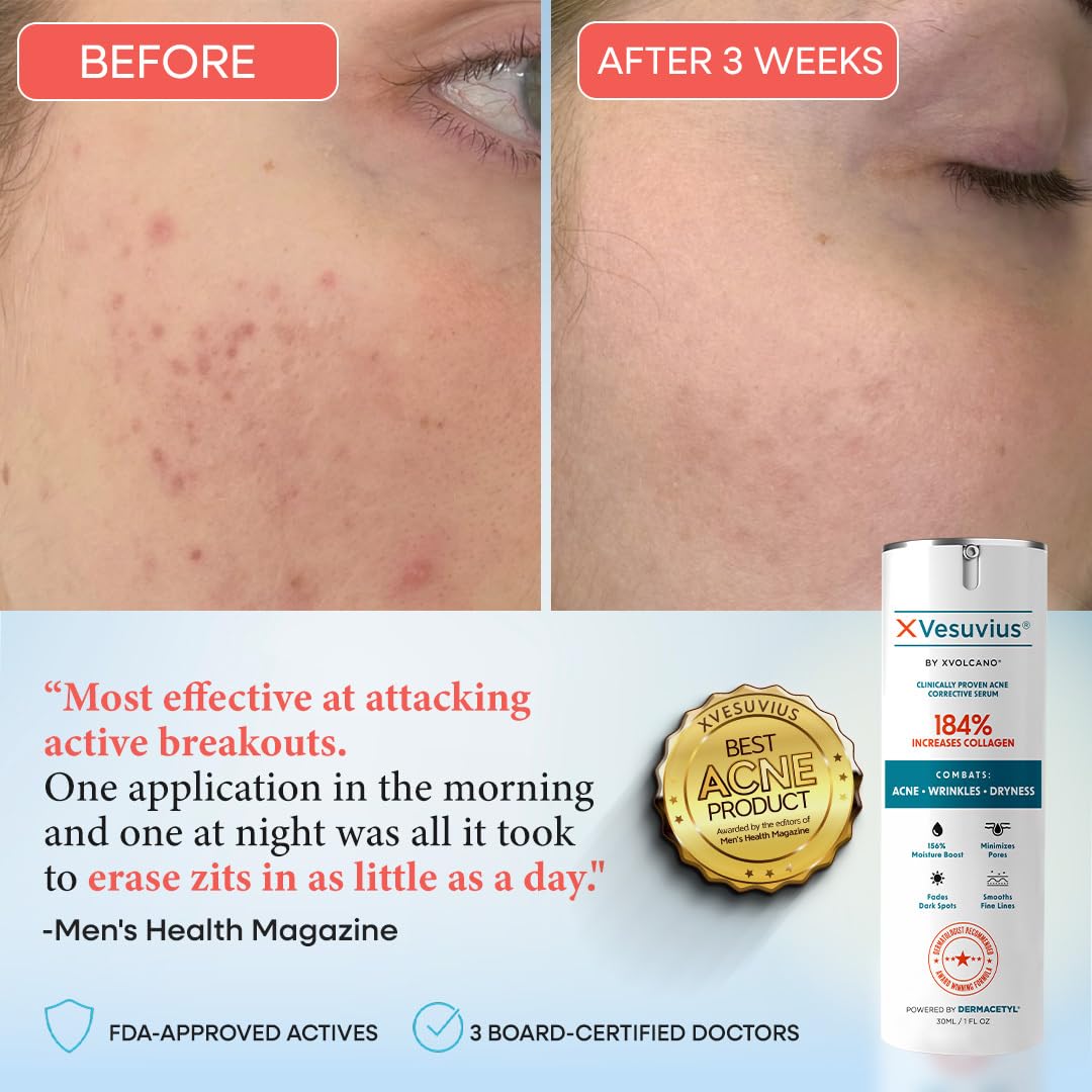 XVesuvius Acne Treatment Serum - Clinical Strength Formula with 2% Salicylic Acid & Retinol - Clears Breakouts, Fades Scars, Anti-Aging - 30ml (1 Beauty & Personal Care xvolcano