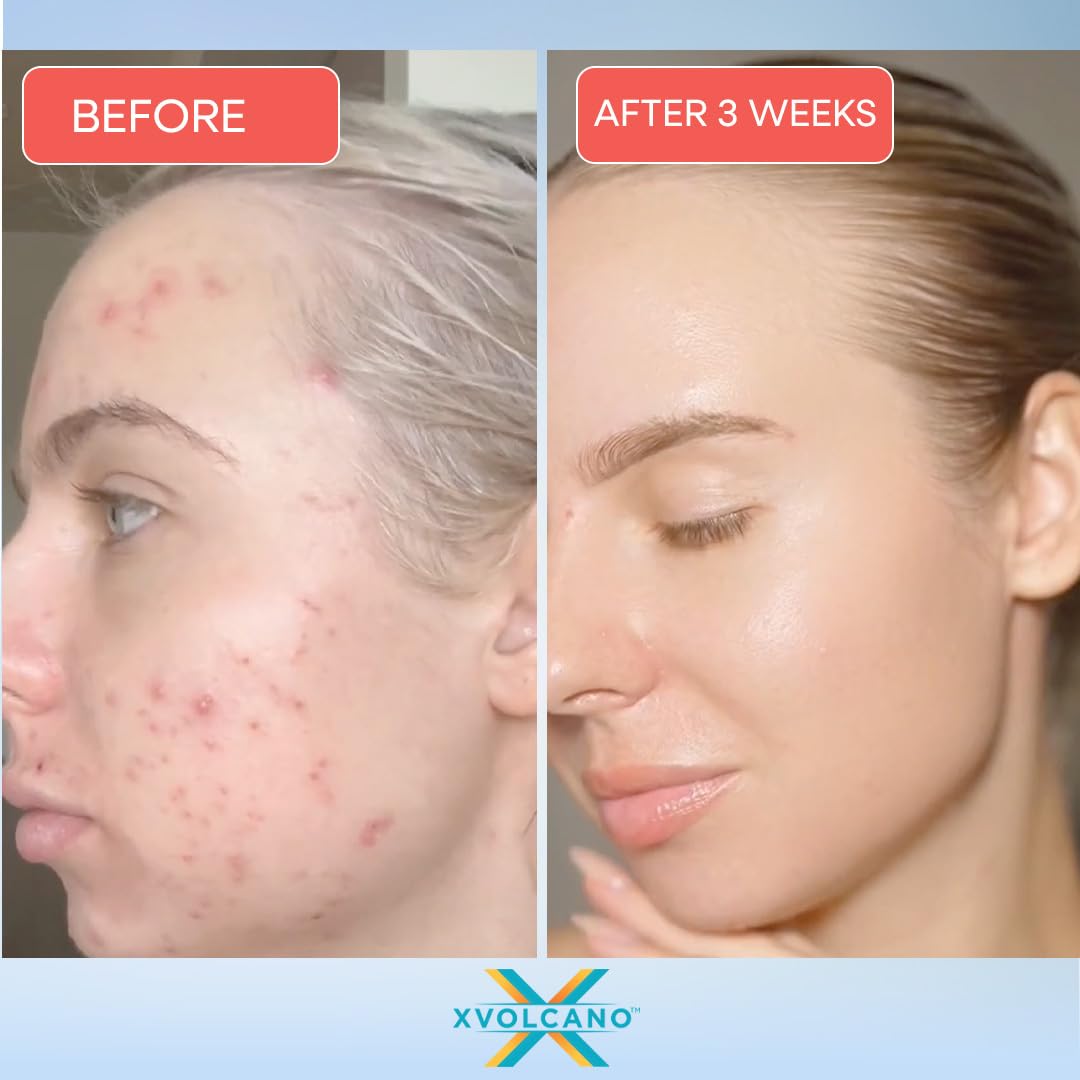 XVesuvius Acne Treatment Serum - Clinical Strength Formula with 2% Salicylic Acid & Retinol - Clears Breakouts, Fades Scars, Anti-Aging - 30ml (1 Beauty & Personal Care xvolcano