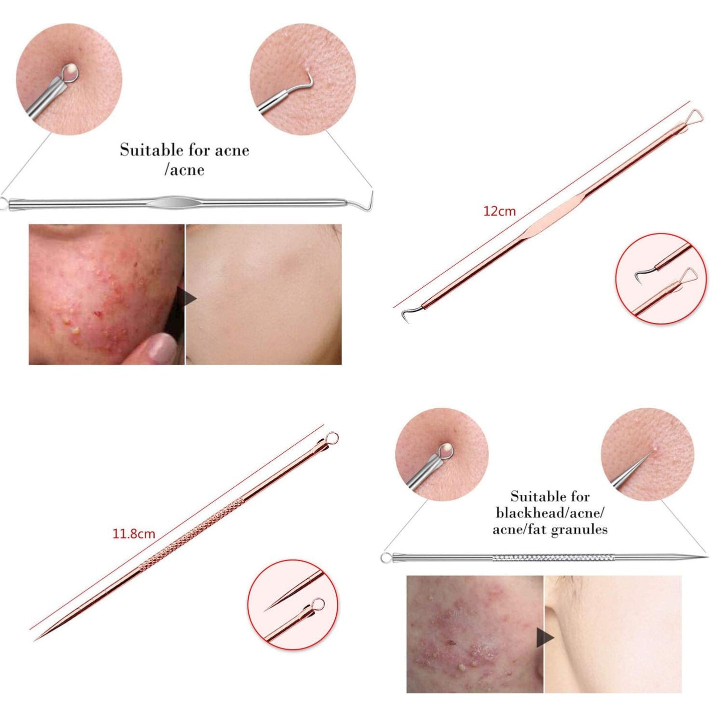 ZTRHYOO Blackhead Remover Pimple Comedone Extractor Tool Best Acne Removal Kit - Treatment for Blemish, Whitehead Popping, Zit Removing for Risk Free Beauty and Personal Care ZTRHYOO
