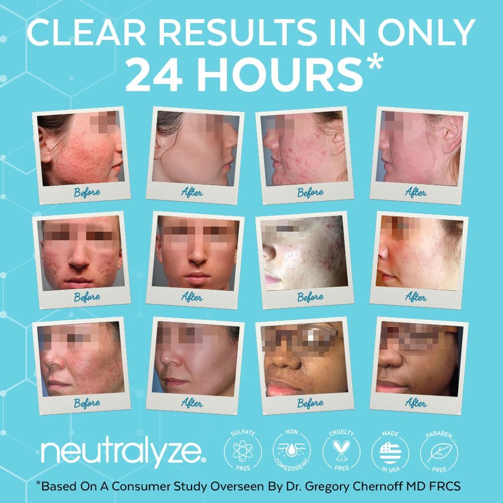 Neutralyze Acne Moisturizer for Face - Time-Release 2% Salicylic + 1% Mandelic Acid - Daily Lotion for Acne-Prone, Hormonal & Sensitive Skin Beauty & Personal Care Neutralyze