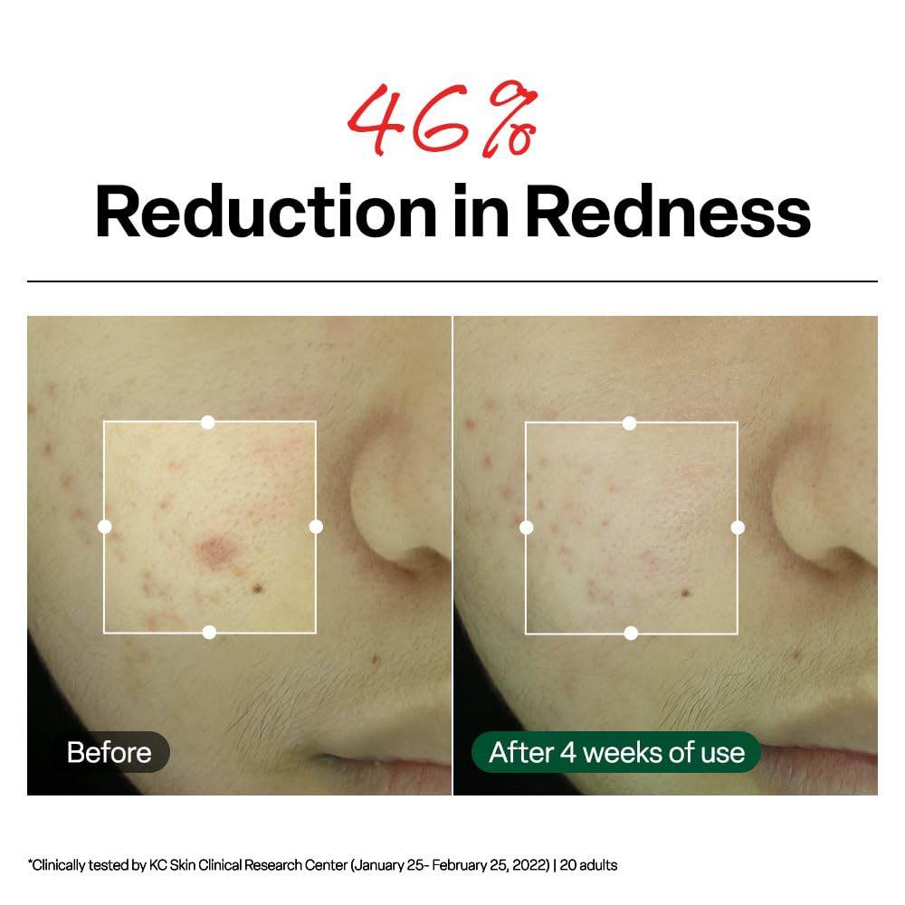 Dr. G R.E.D. Blemish Clear Soothing Cream - Calming Korean Moisturizer for Redness - Soothes Acne & Irritation - With Centella Asiatica - Long-Lasting Beauty & Personal Care Dr.G