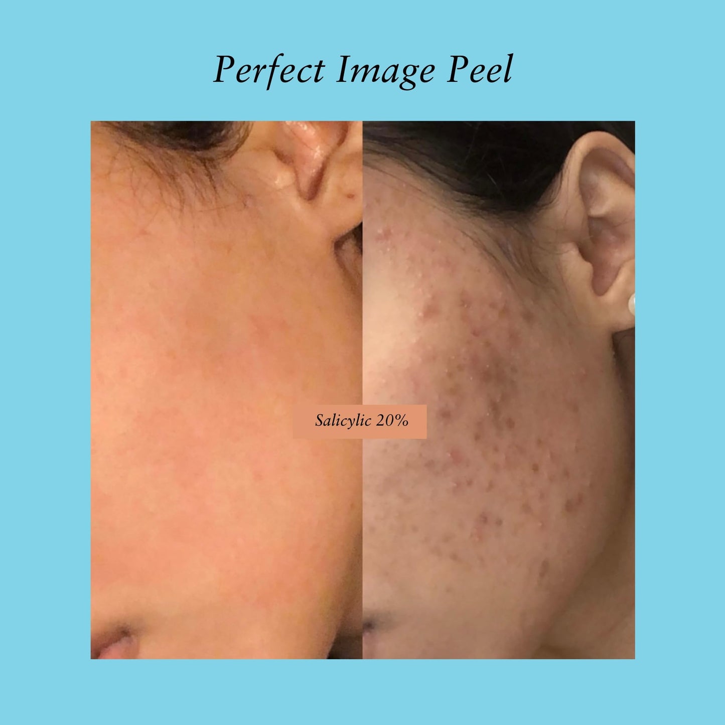 Salicylic Gel Chemical Peel - Enhanced with Green Tea Extract and Tea Tree Oil (20% Strength) Beauty & Personal Care Perfect Image