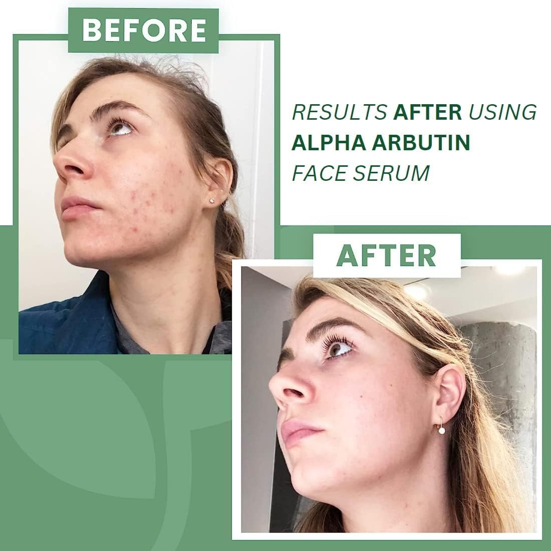 OTAA 2% Alpha Arbutin Serum for Pigmentation & Dark Spots Removal - Anti-pigmentation Face Serum For Men & Women with Hyaluronic Acid to Remove Beauty & Personal Care OTAA
