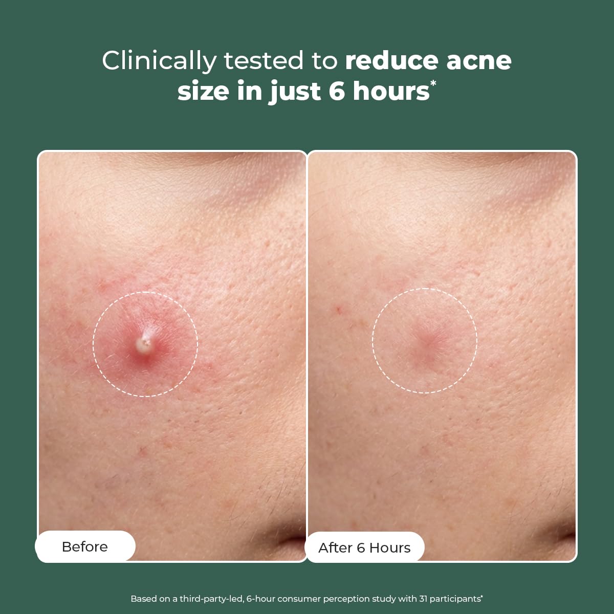 Acne Spot Corrector Gel Serum Beauty & Personal Care Conscious Chemist