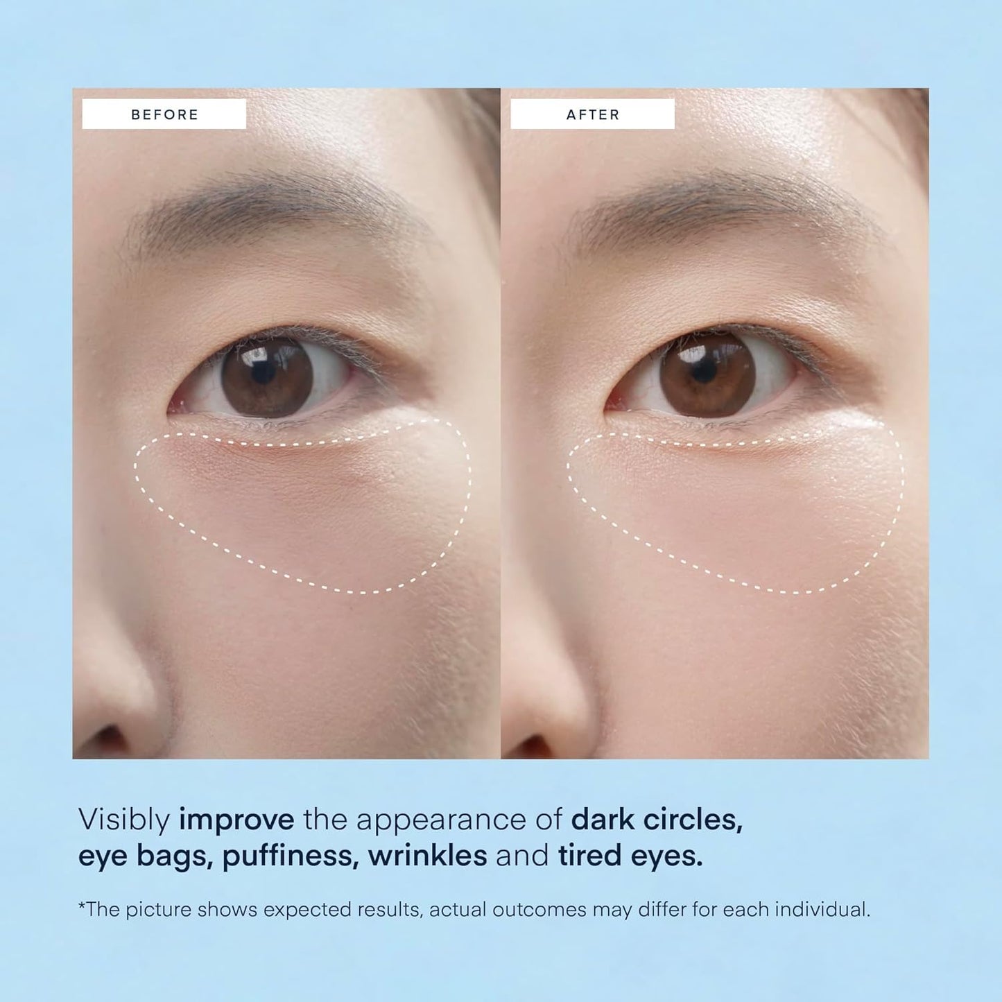 Terez & Honor Under Eye Patches for Dark Circles - 60 Korean Hydrogel Masks for Puffiness, Bags, Wrinkle with Caffeine, Hyaluronic Acid, Niacinamide Beauty & Personal Care TEREZ & HONOR