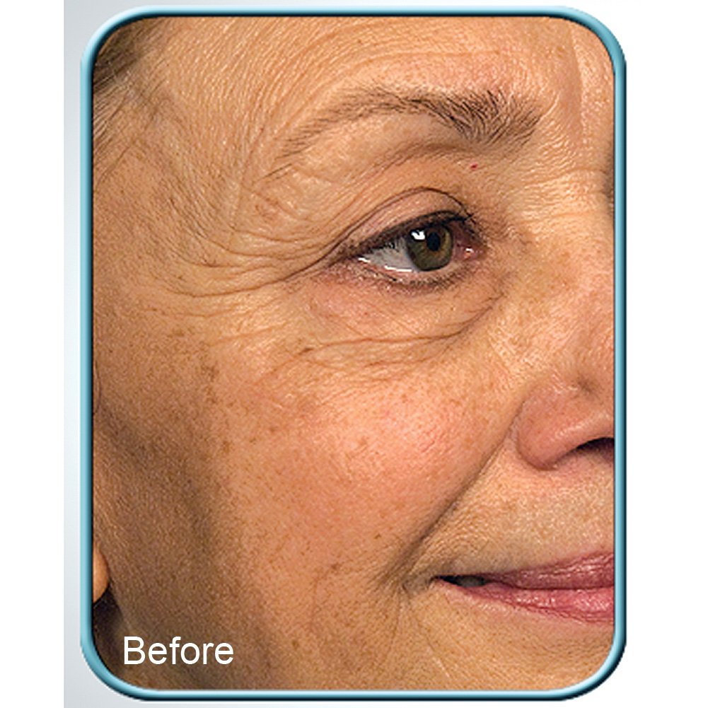 Biologic Stem Cell Therapy (Set of 4 Jars) for Deep Wrinkles - by BioLogic Beauty & Personal Care Biologic Solutions