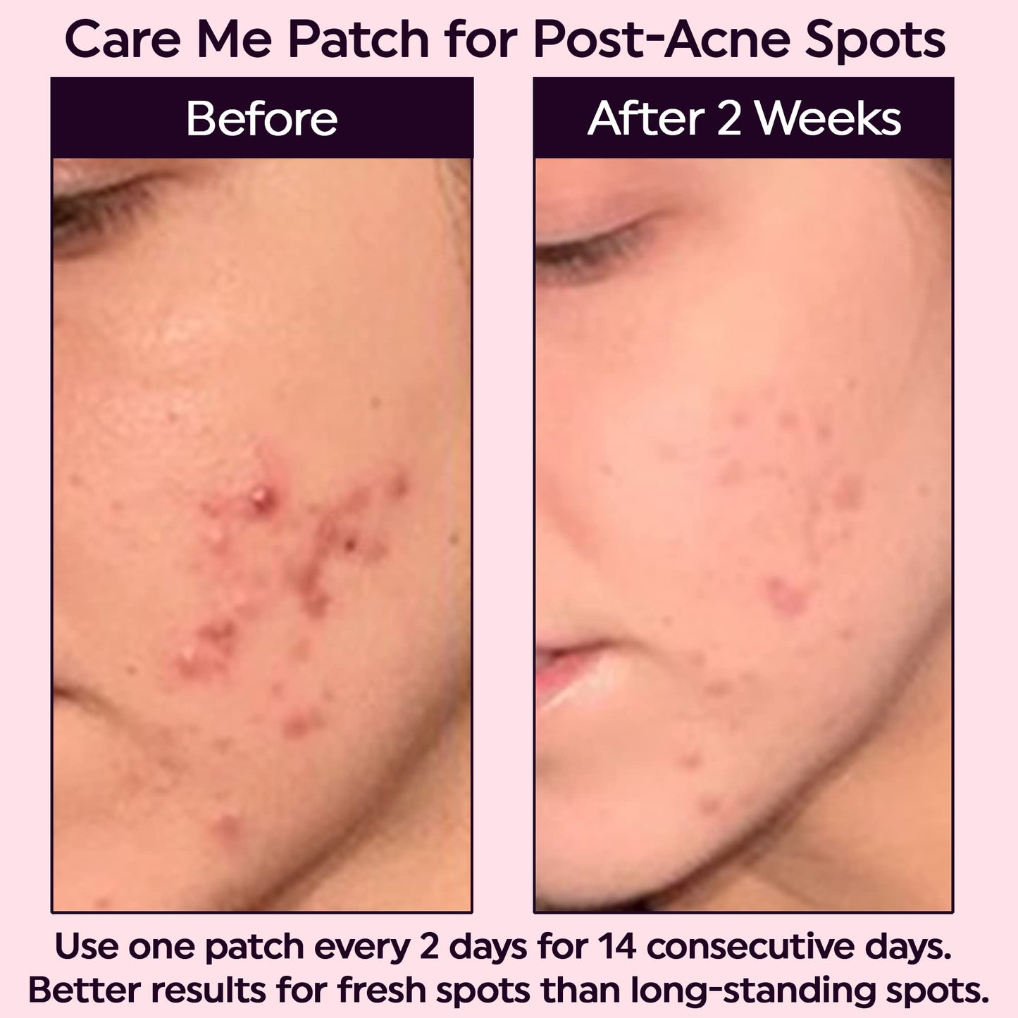 Microdart Dark Spot Patch with 127 Micropoints (1 Pack of 9 Patches) - Fades & Brightens Acne Marks, Dark Spots & Discoloration - Post-Acne Treatment Beauty & Personal Care Care me
