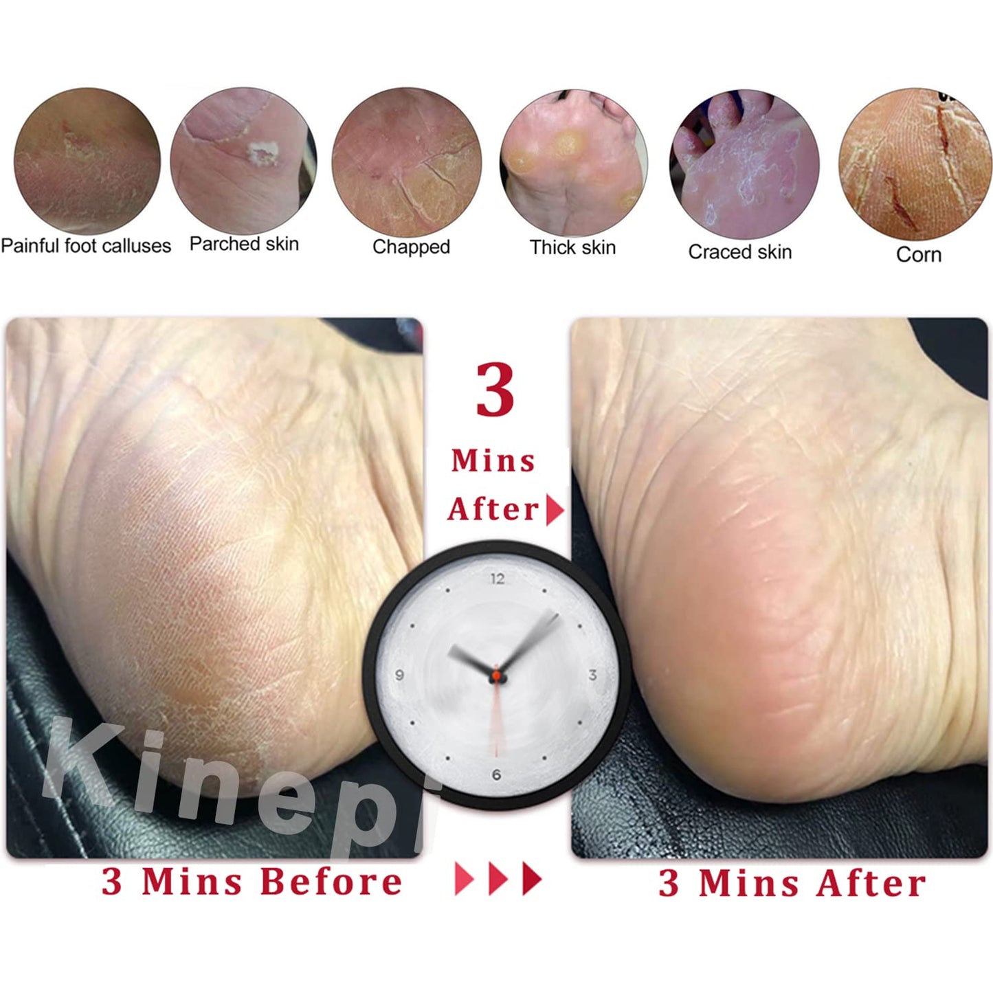 Kinepi Callus Remover Foot Scrubber Colossal Foot File Foot Care and Foot Exfoliator Foot Rasp Pedicure Tools Pumice Stone for Feet,Remove Corn Hard Beauty & Personal Care Kinepi