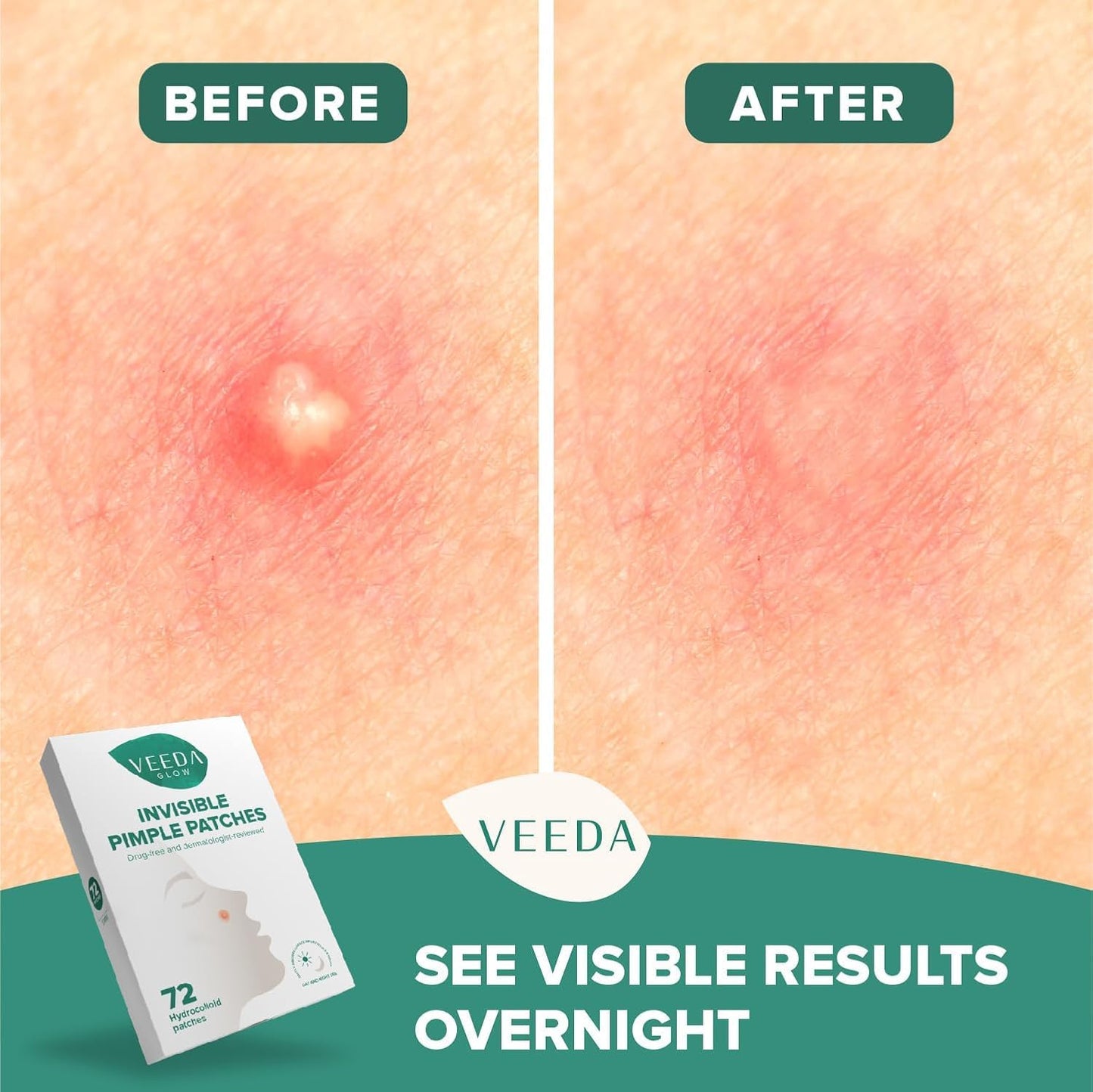 Veeda Glow Pimple Patches - Hydrocolloid Acne Stickers for Fast Healing, Invisible & Non-Irritating Zit Covers, Blemish Spot Treatment, 72 Count Beauty & Personal Care Veeda