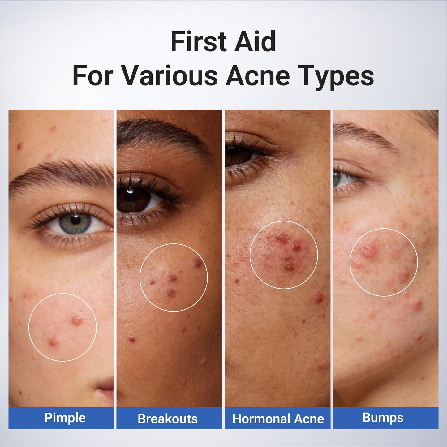 Dr.Leo 1.8% Salicylic Acid Acne Treatment, Drying Lotion Acne Spot Treatment for Acne-Prone Sensitive Skin | Niacinamide, Fast Pimple Relief, Fades Beauty and Personal Care Dr.Leo