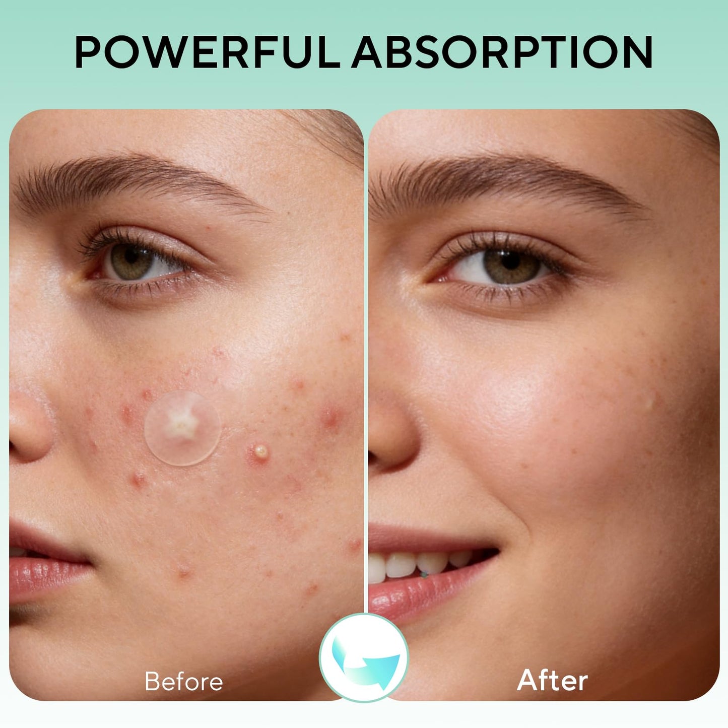QUSTERE 580 Count Pimple Patches for Face, Large Hydrocolloid Acne Patches Stickers Bandages, Blemishes Zit Breakouts for Cheeks, Forehead, Chin, Nose Beauty and Personal Care QUSTERE
