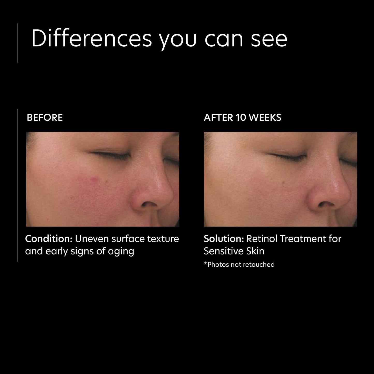 PCA SKIN Retinol Treatment for Sensitive Skin - Anti Aging Face Serum to Gently Reduce Redness & Minimize Fine Lines & Wrinkles - Contains Vitamin A Beauty & Personal Care PCA SKIN