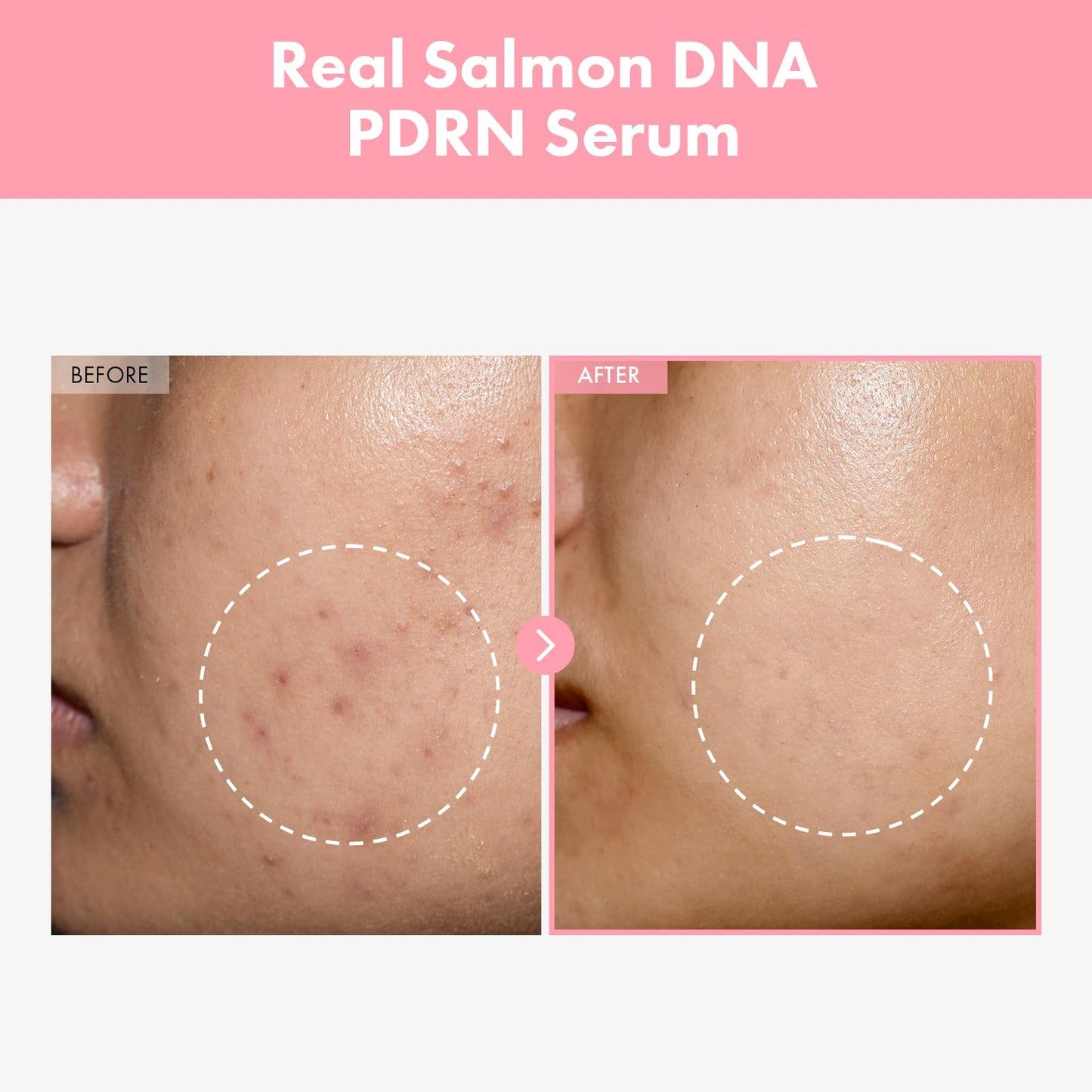 TOSOWOONG Pink Peptide 12 PDRN Serum With Salmon DNA PDRN 10,320ppm, 12 Peptides, Niacinamide, Skin glow, Hydrating, Moisturizing, Firming, Uneven Beauty and Personal Care TOSOWOONG
