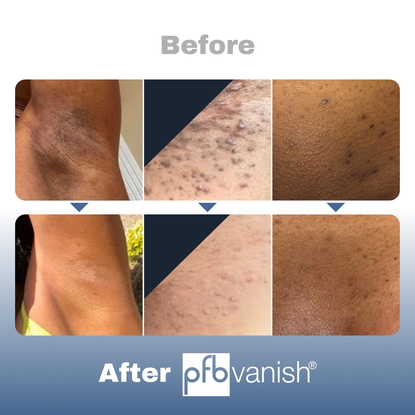 PFB Vanish Razor Bump Stopper Skin Care Treatment with Chromabright Dark Spot Remover, Roll On Formula Treats Ingrown Hairs and Razor Burns - 93g Beauty & Personal Care PFB Vanish