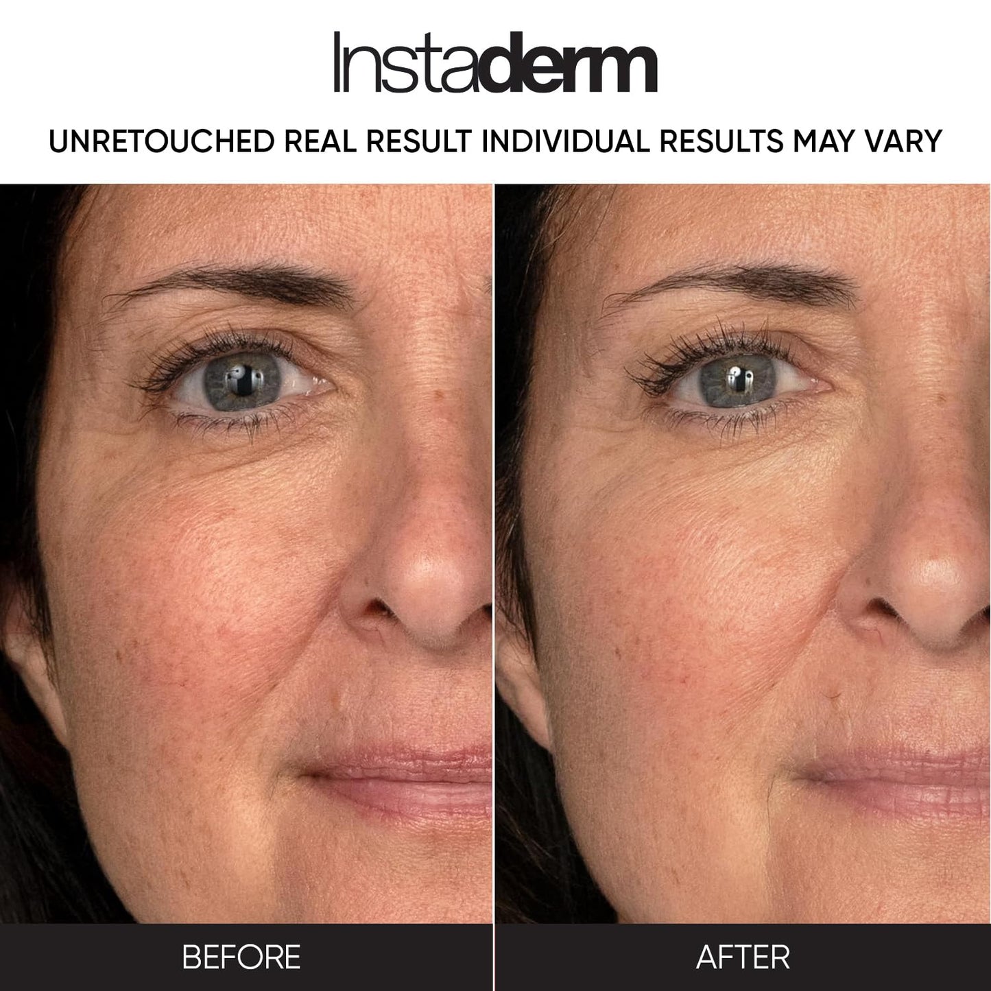 Anti-Aging Resurfacing Pads - Smooth’s Fine Lines, Wrinkles, Dark Spots & Skin Roughness to Enhance the Skins Texture & Tone for Radiant Glow. Beauty & Personal Care Instaderm