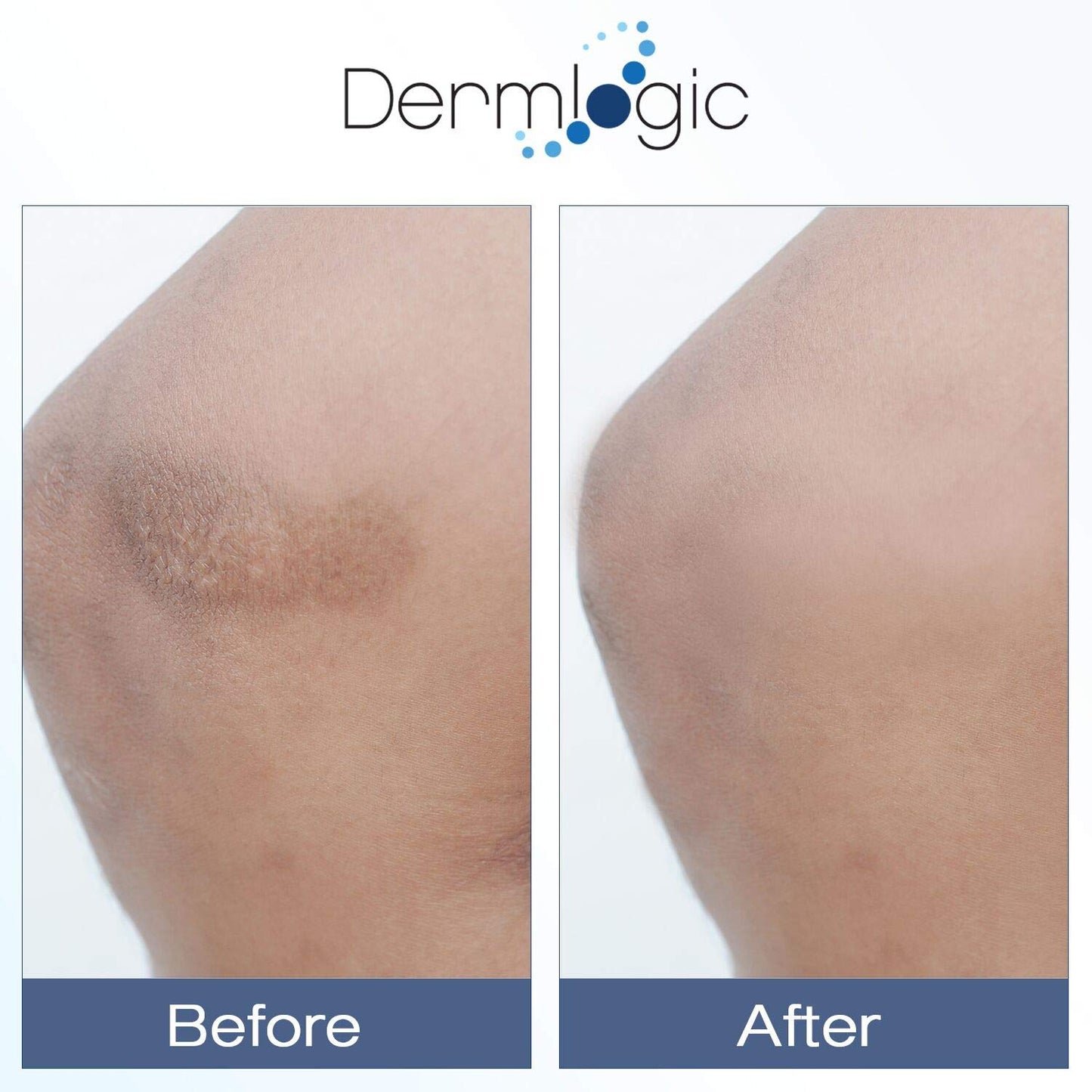 Vitamin K Cream- Moisturizing Bruise Healing Formula. Dark Spot Corrector for Bruising, Spider Veins & Broken Capillaries. Reduces Under Eye Dark Beauty & Personal Care Dermlogic