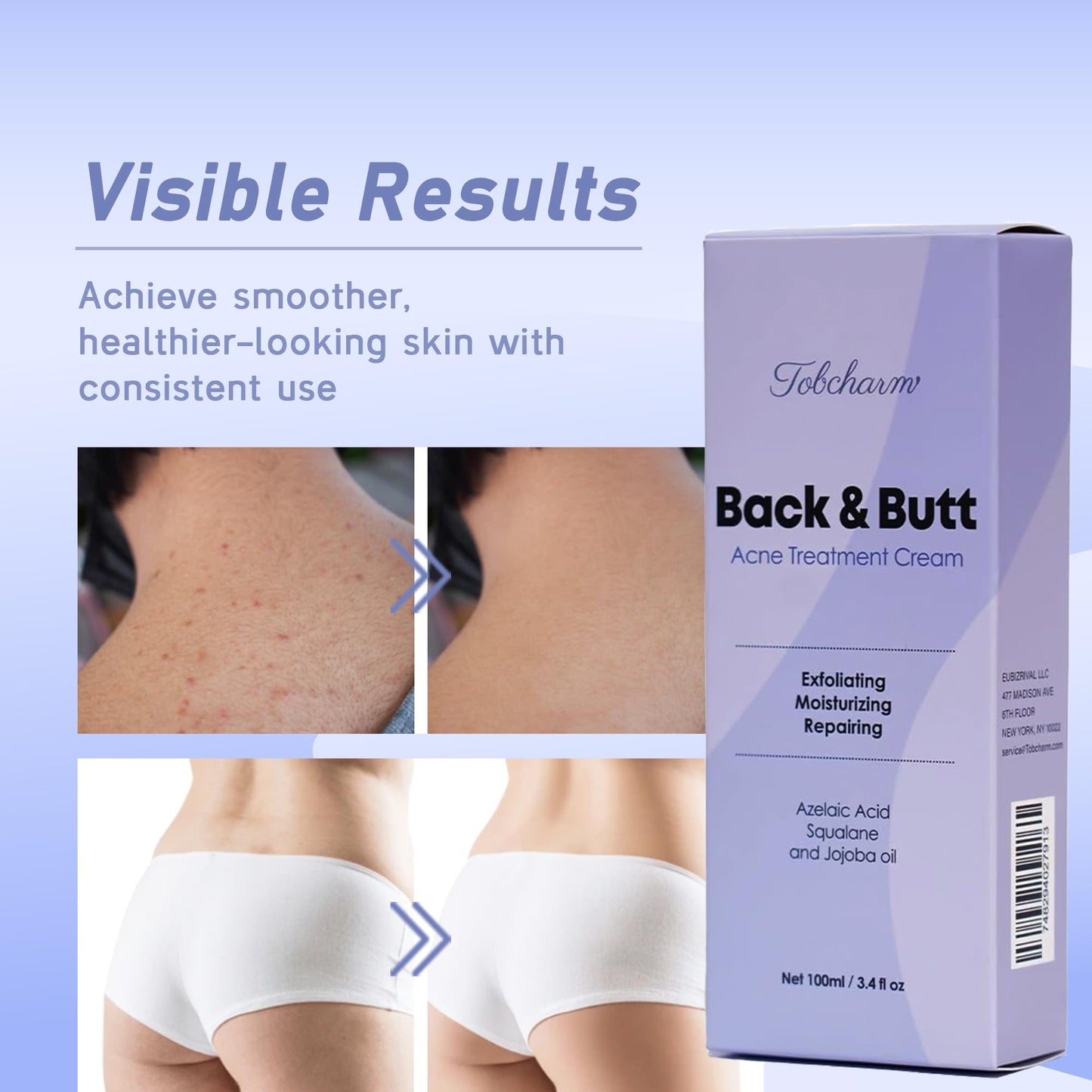 Butt Acne Clearing Treatment, Maximum Strength Body Cream for Back, Buttocks, Thigh & Chest Acne Removal, Skin Clearing Lotion for Men & Women Beauty & Personal Care Tobcharm