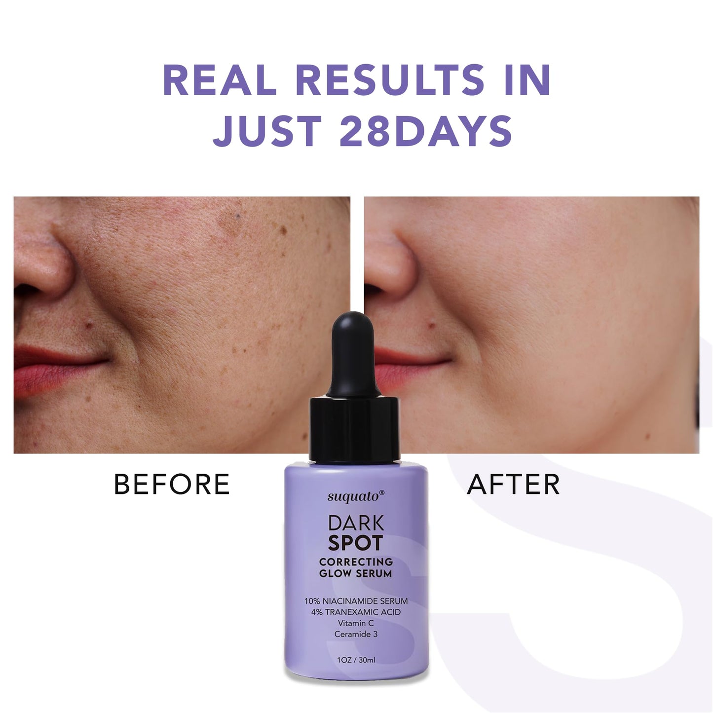 suquato Dark Spot Remover Serum - For Face Hyperpigmentation & Melasma Care - Dark Spot Correcting Glow with Tranexamic Acid + Niacinamide + Vitamin C Beauty & Personal Care suquato