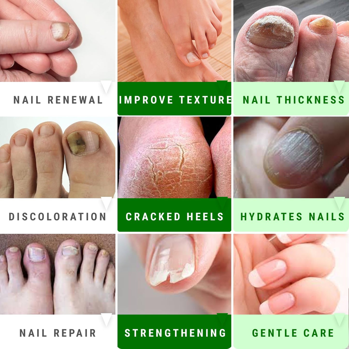 Urea Nail Gel - Softens Cracked Heel Calluses & Thick Toenails - Repairs Damaged, Yellow, Discolored Nails - Highly Effective & Quick-Dry Fingernails Beauty & Personal Care Scientific Solutions Global