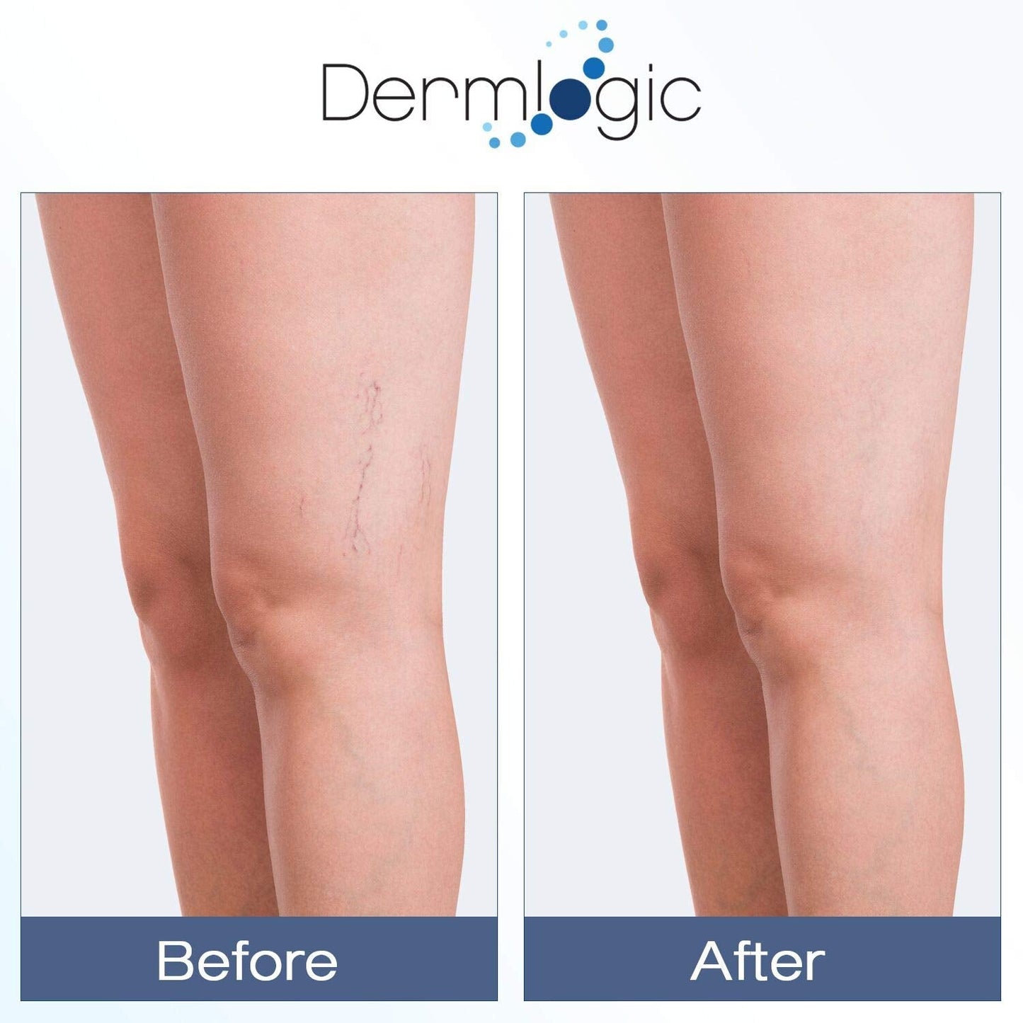 Vitamin K Cream- Moisturizing Bruise Healing Formula. Dark Spot Corrector for Bruising, Spider Veins & Broken Capillaries. Reduces Under Eye Dark Beauty & Personal Care Dermlogic