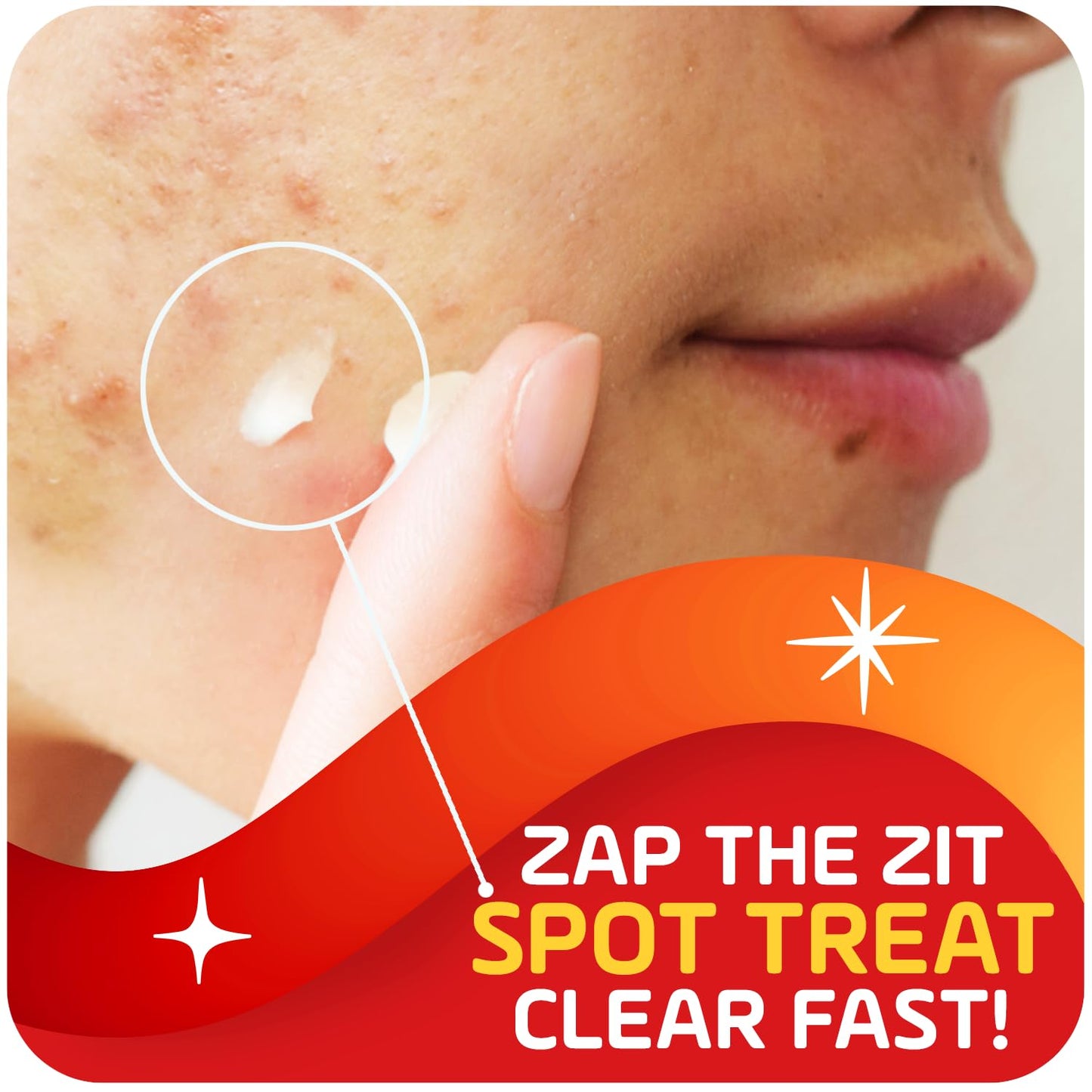 Asepxia 2% Salicylic Acid Acne Spot Treatment Cream | Drying Formula Targets Acne, Clears & Prevents Blemishes, Reduces Redness, Penetrates Pores Beauty & Personal Care Asepxia