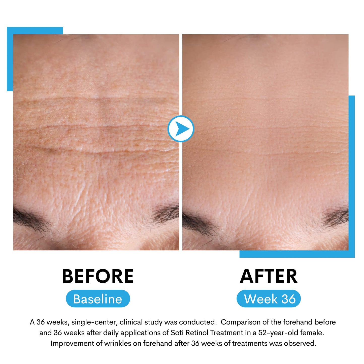 Retinol Face Serum, Reduces Wrinkles, Age Spots, Post-Acne Marks. Stimulates Collagen, Firm Skin, Anti Aging with Hyaluronic Acid, Niacinamide (30ml) Beauty & Personal Care Soti