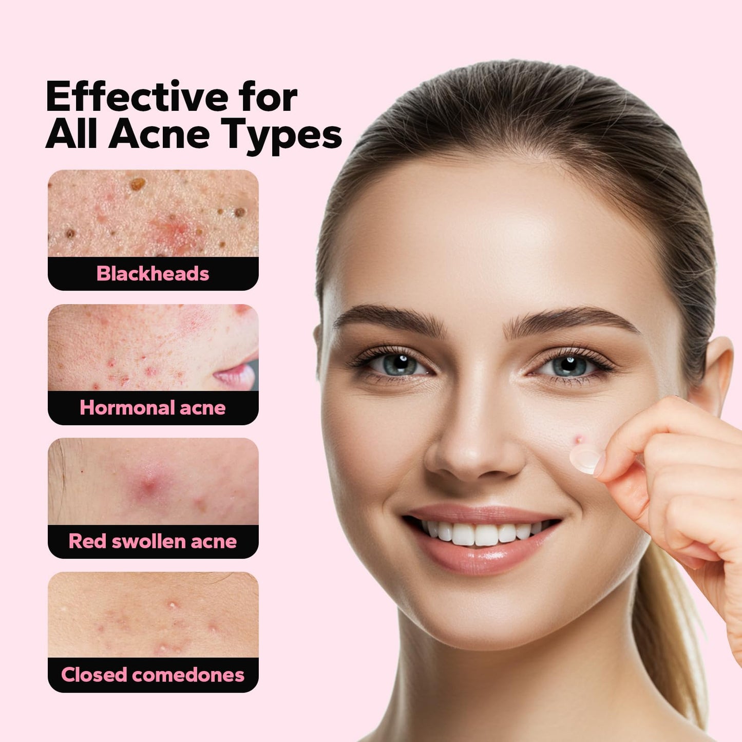 CharmCherry Pimple Patches for Face (18 Count), Microdart Acne Patches, Hydrocolloid Blemish Spot with Salicylic Acid, Fast-Acting for Early Stage Beauty & Personal Care CharmCherry