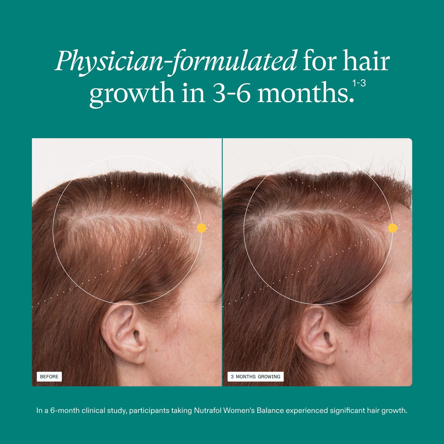 Nutrafol Women's Balance Hair Growth Supplements, Ages 45 and Up, Clinically Proven for Visibly Thicker Hair and Scalp Coverage, Dermatologist Beauty & Personal Care Nutrafol