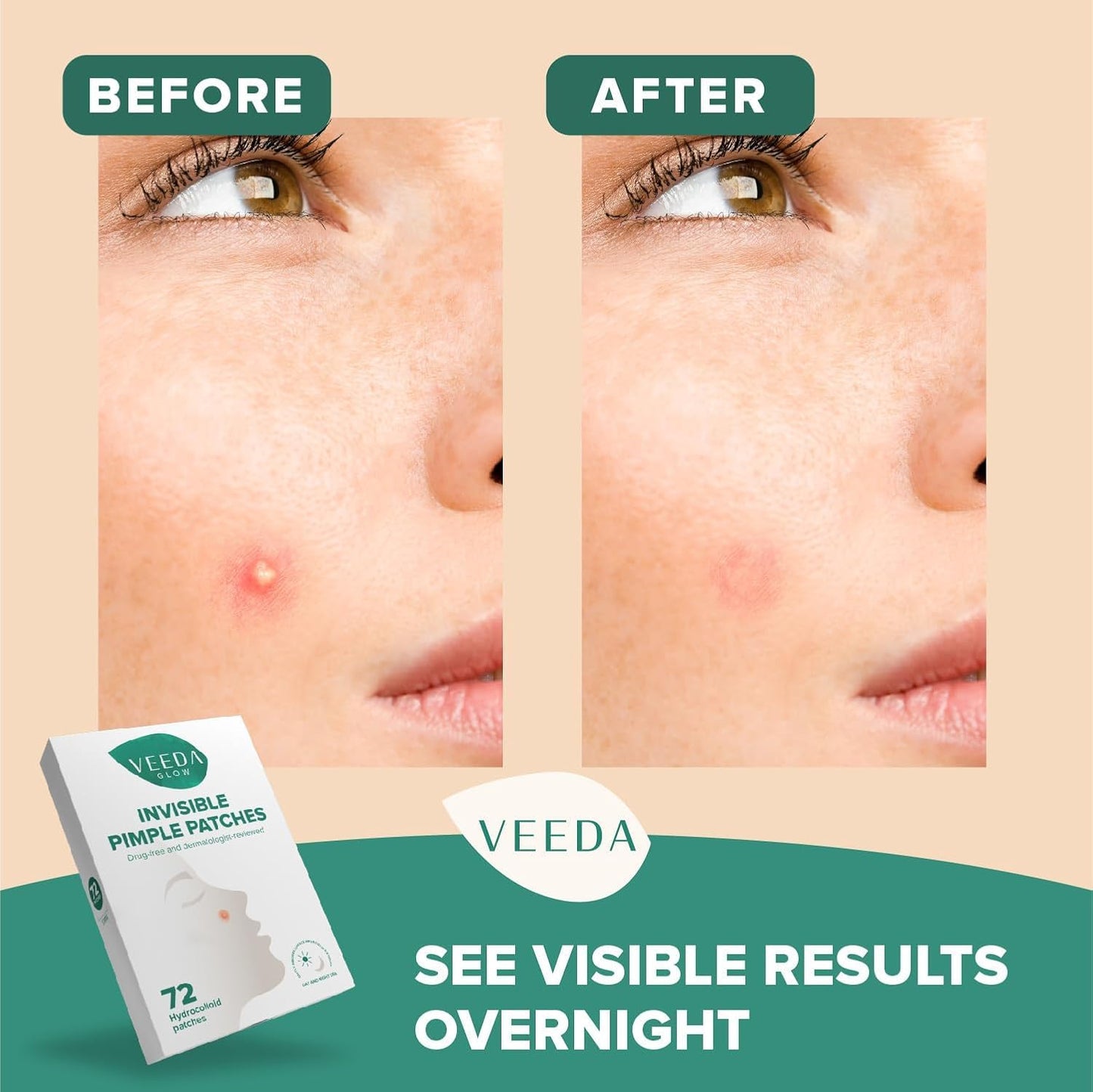 Veeda Glow Pimple Patches - Hydrocolloid Acne Stickers for Fast Healing, Invisible & Non-Irritating Zit Covers, Blemish Spot Treatment, 72 Count Beauty & Personal Care Veeda