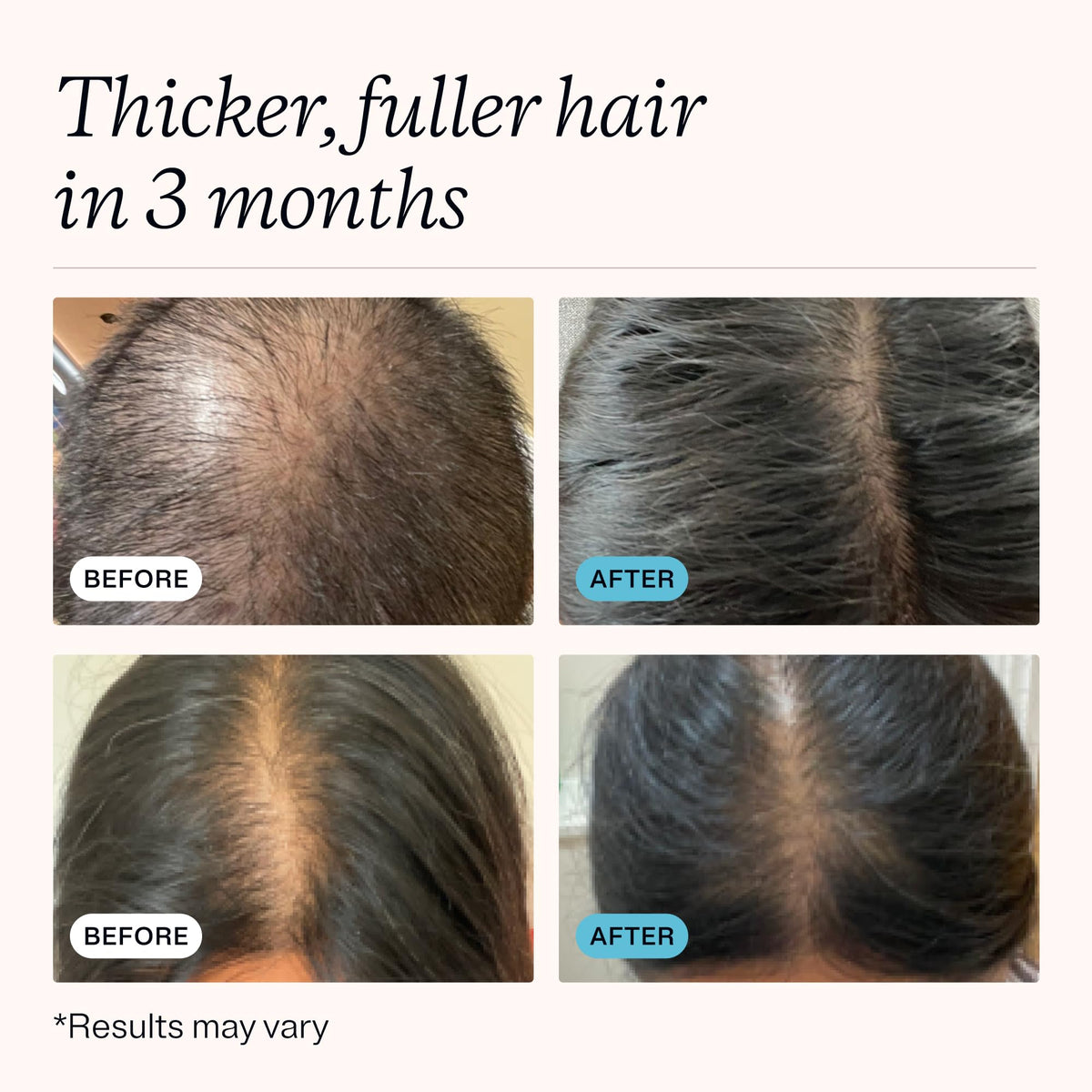 MDhair Restore Supplements - Hair Growth Vitamins with Biotin & Iron