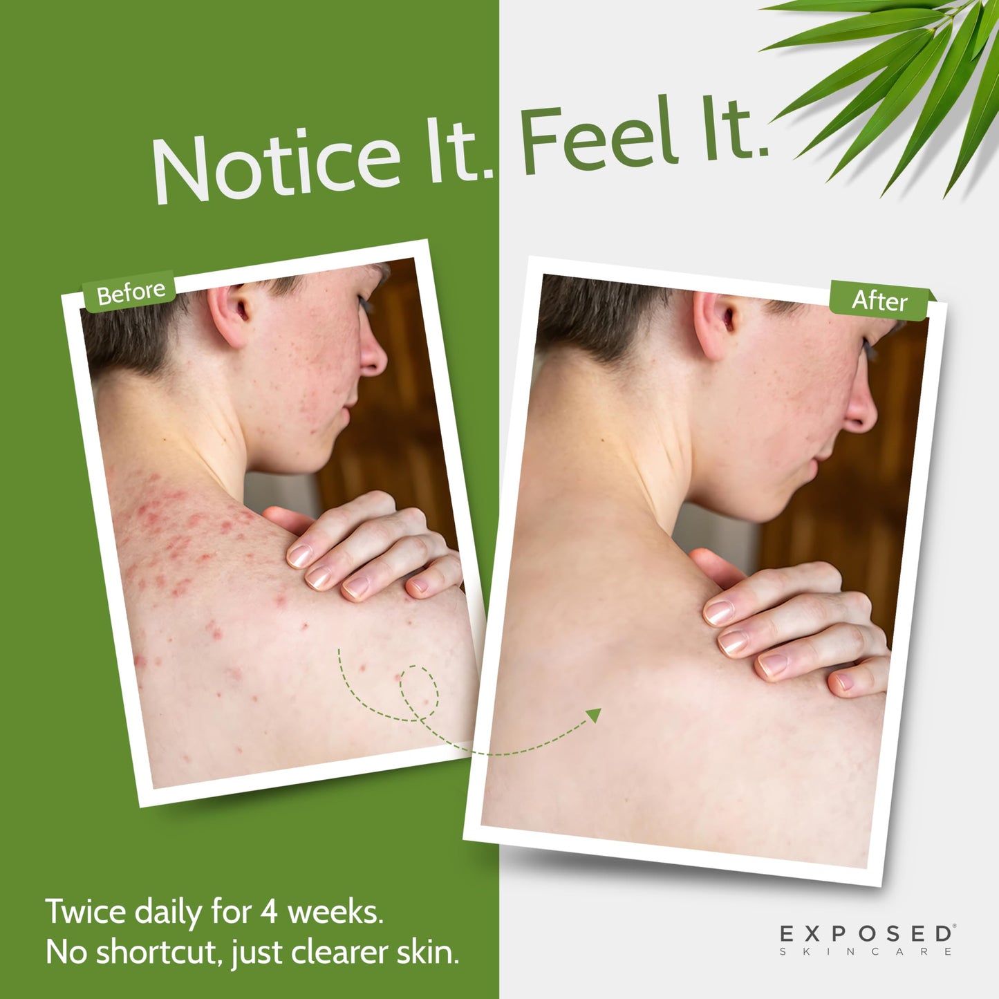 Exposed Skin Care, Body Acne Wash with Salicylic Acid, Glycolic Acid and Tea Tree Oil - Tri-Powered Gentle Exfoliating Cleanser for Back, Chest Beauty & Personal Care Exposed Skin Care