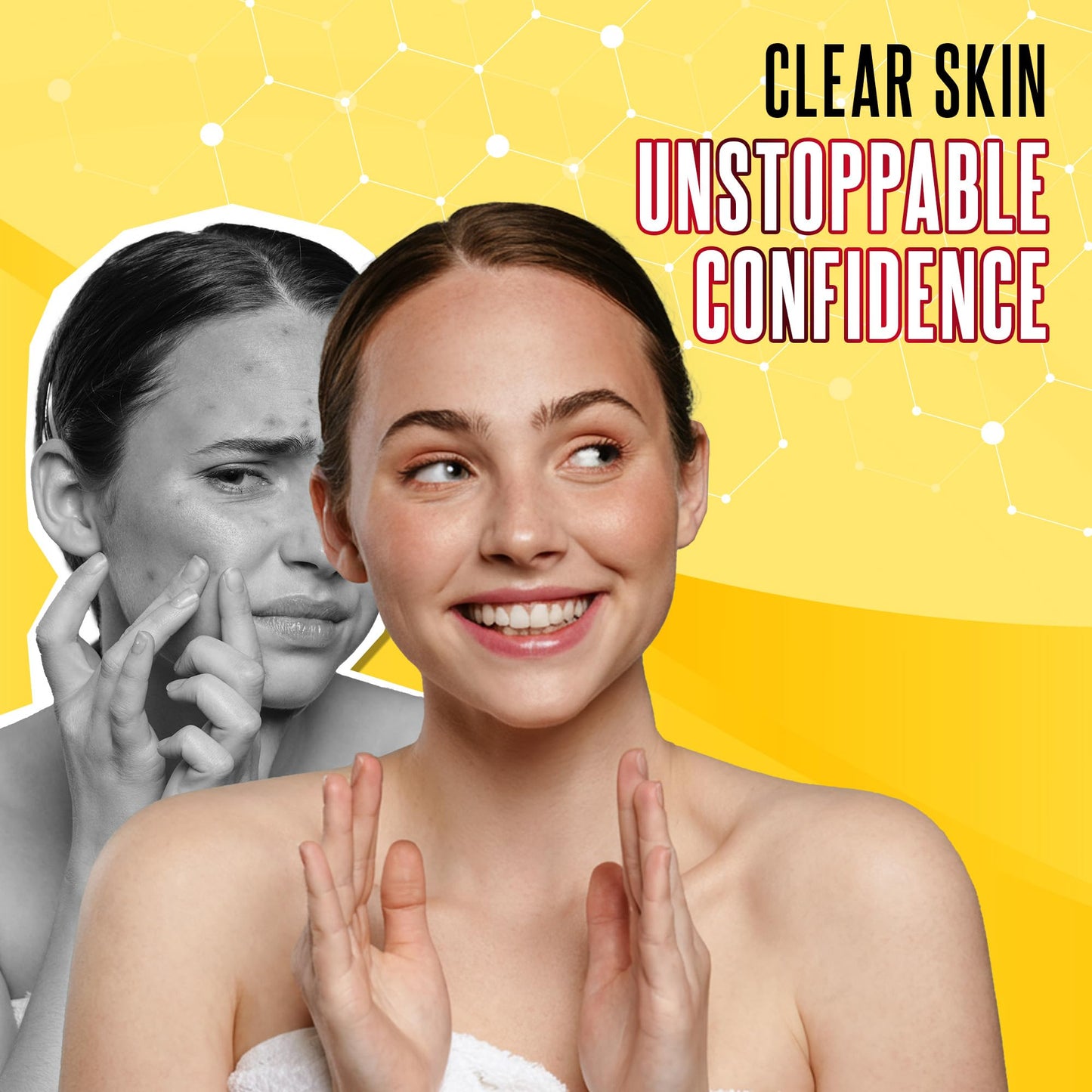 Biosulfur Grisi Acne Treatment Soap: Deep Cleansing, Acne-Fighting, Reduces Inflammation, Prevents Breakouts, Blackheads, Excess Oil, Sulfur Soap Bar Beauty & Personal Care Biosulfur