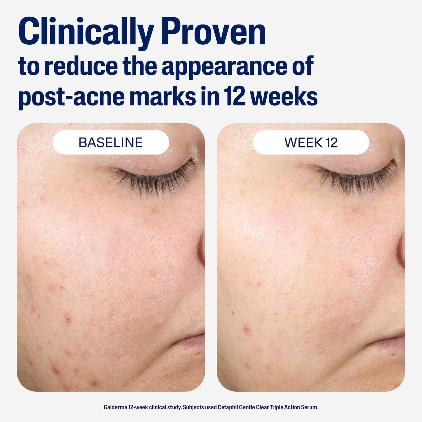 CETAPHIL Gentle Clear Repairing Post-Acne Serum, Retinol Alternative, Oil Free Serum for Sensitive Skin, 1 Fl Oz, Bakuchiol, Improves Skin Tone Beauty & Personal Care Cetaphil