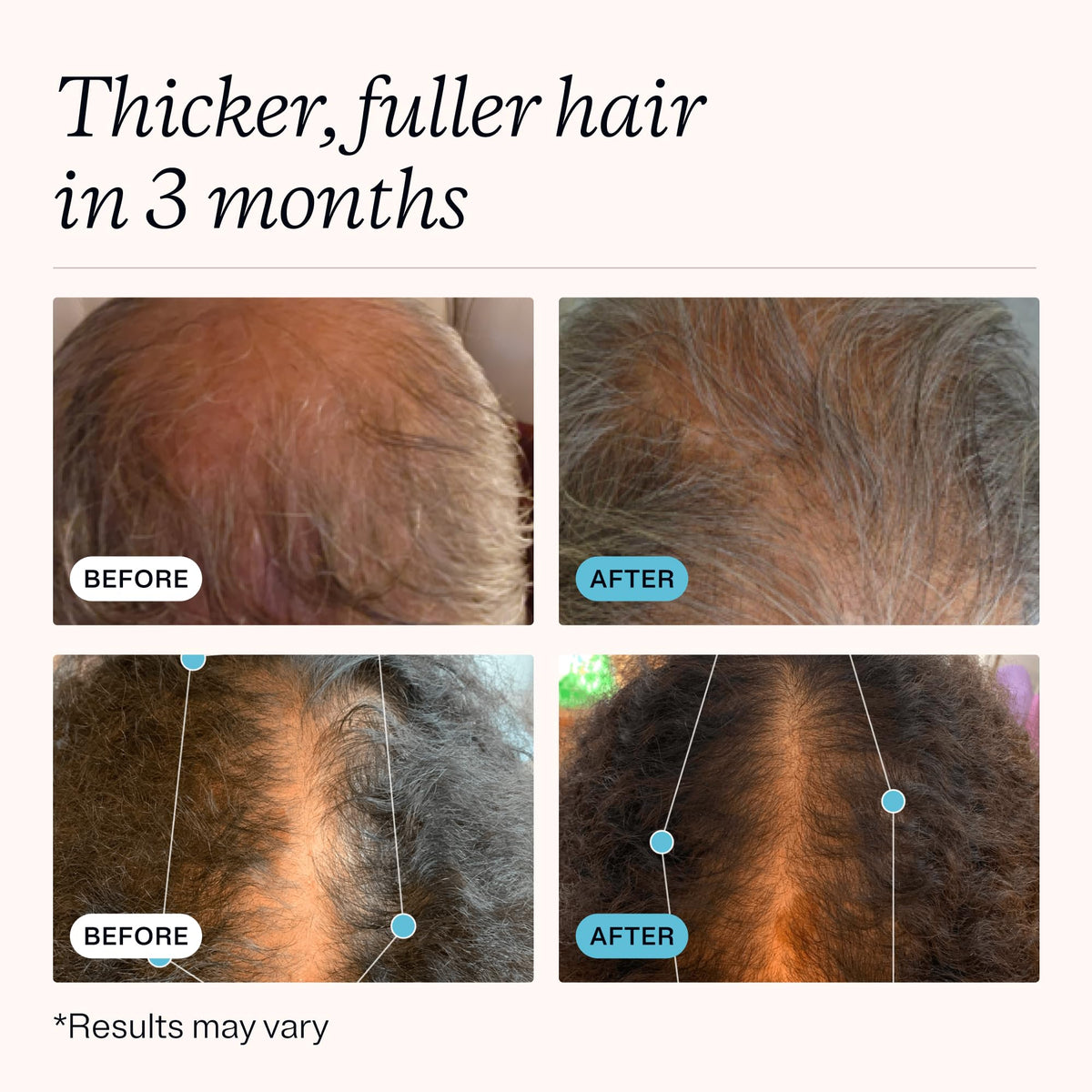 MDhair Regrowth Supplements - Hair Growth Vitamins for Women & Men