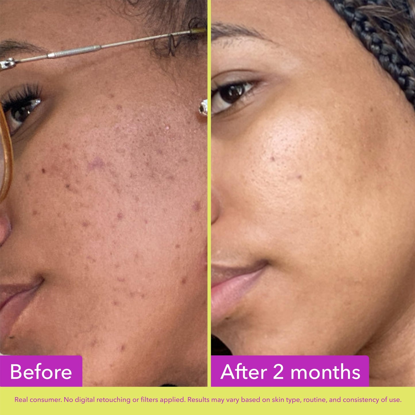 Good Molecules 10% Azelaic Acid Treatment for Face - Blurs Facial Redness & Evens Skin Tone - Brightens the Look of Dark Spots & Refines Texture Beauty and Personal Care Good Molecules