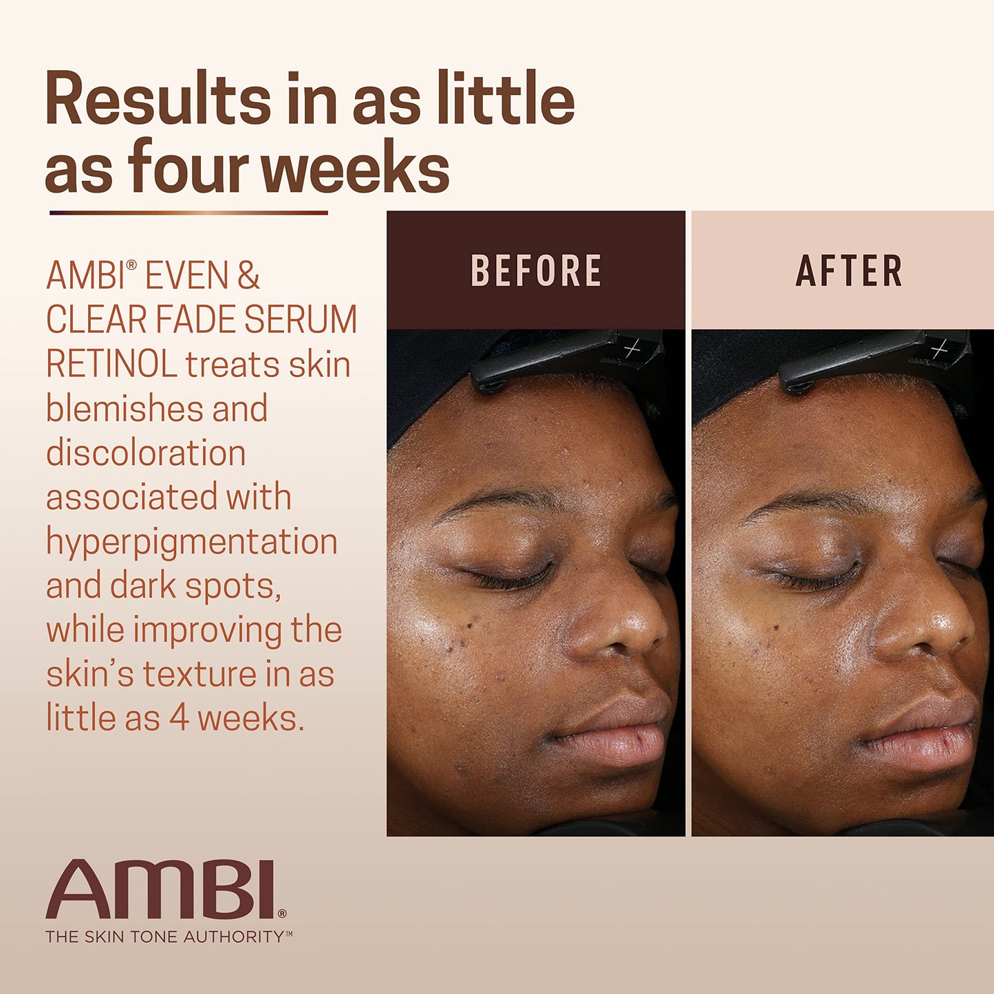 Ambi Even & Clear Fade Serum, Hyperpigmentation Treatment, Hydroquinone-free, Dark Spot Corrector, Results In As Little As 4 Weeks, Retinol Beauty & Personal Care Ambi