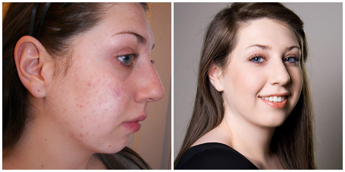 Judith August - EraseZit - Acne & Blemish Pencil (Neutral Light)