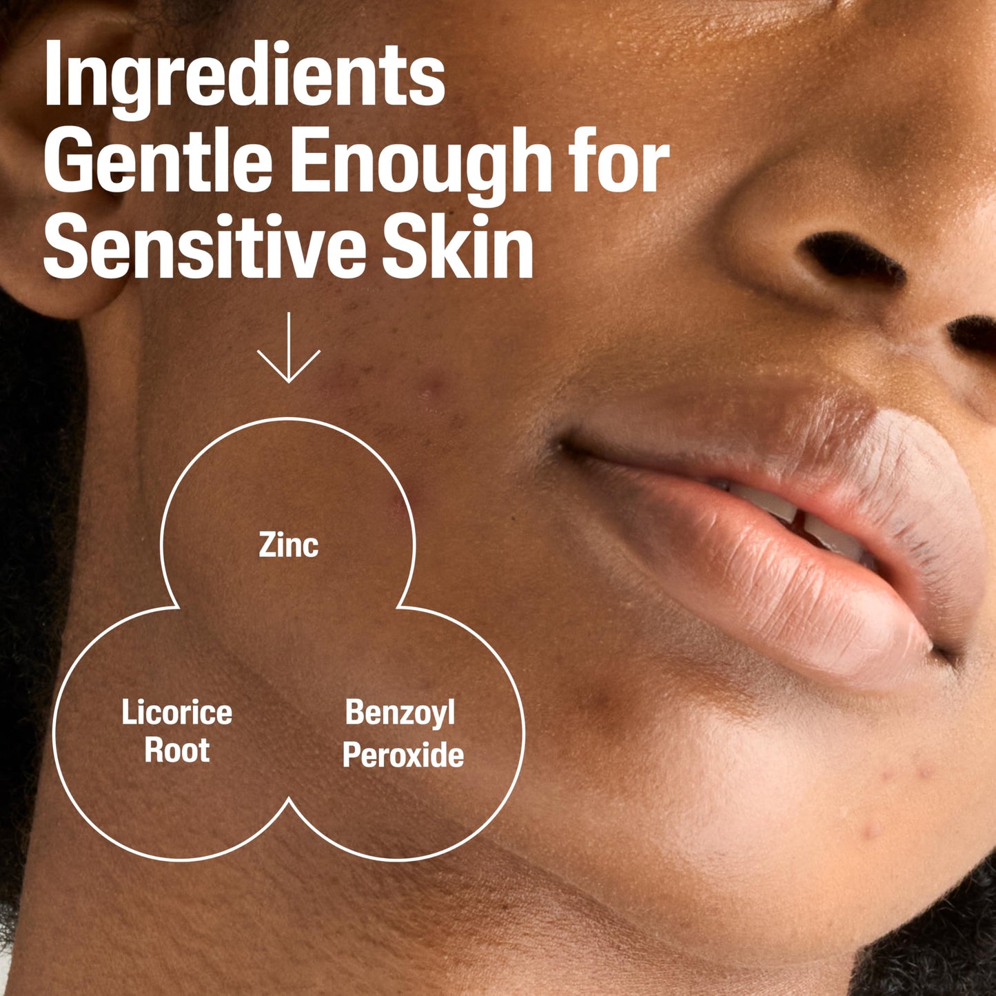 Cetaphil Gentle Clear Complexion-Clearing BPO Acne Cleanser with 2.6% Benzoyl Peroxide, Creamy and Soothing for Sensitive Skin, Suitable for All Skin Beauty & Personal Care Cetaphil