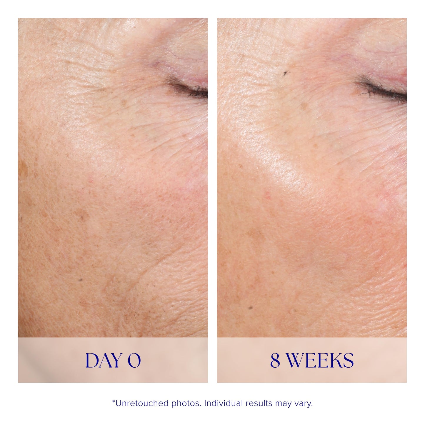 iS CLINICAL Active Peel System, two-step gentle at-home peel system for face Exfoliation Beauty & Personal Care iS CLINICAL