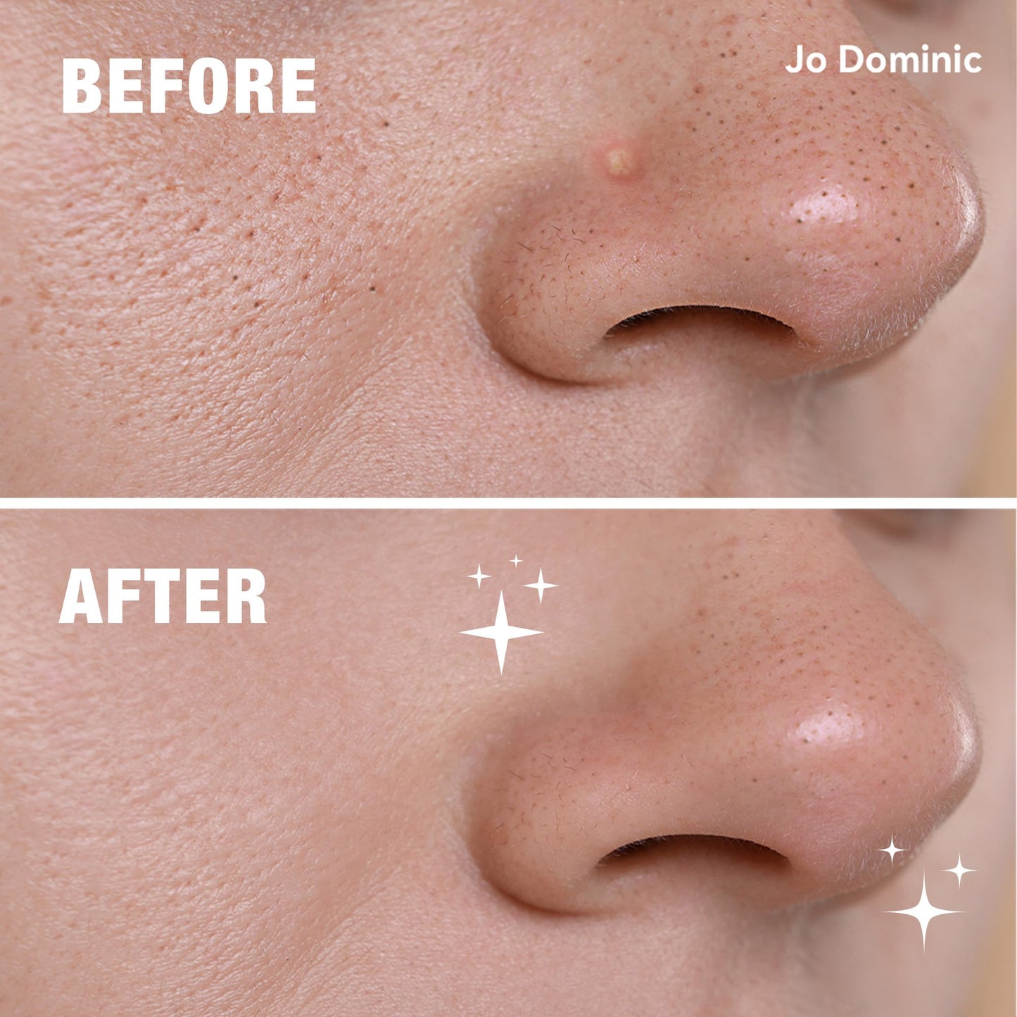 Jo Dominic MAGIX PATCH Nose Pimple Patches Hydrocolloid Acne Patches for Nose Pores - Absorbs Oil, Zits & Blemishes Overnight - Vegan, Cruelty-Free Beauty and Personal Care Jo Dominic