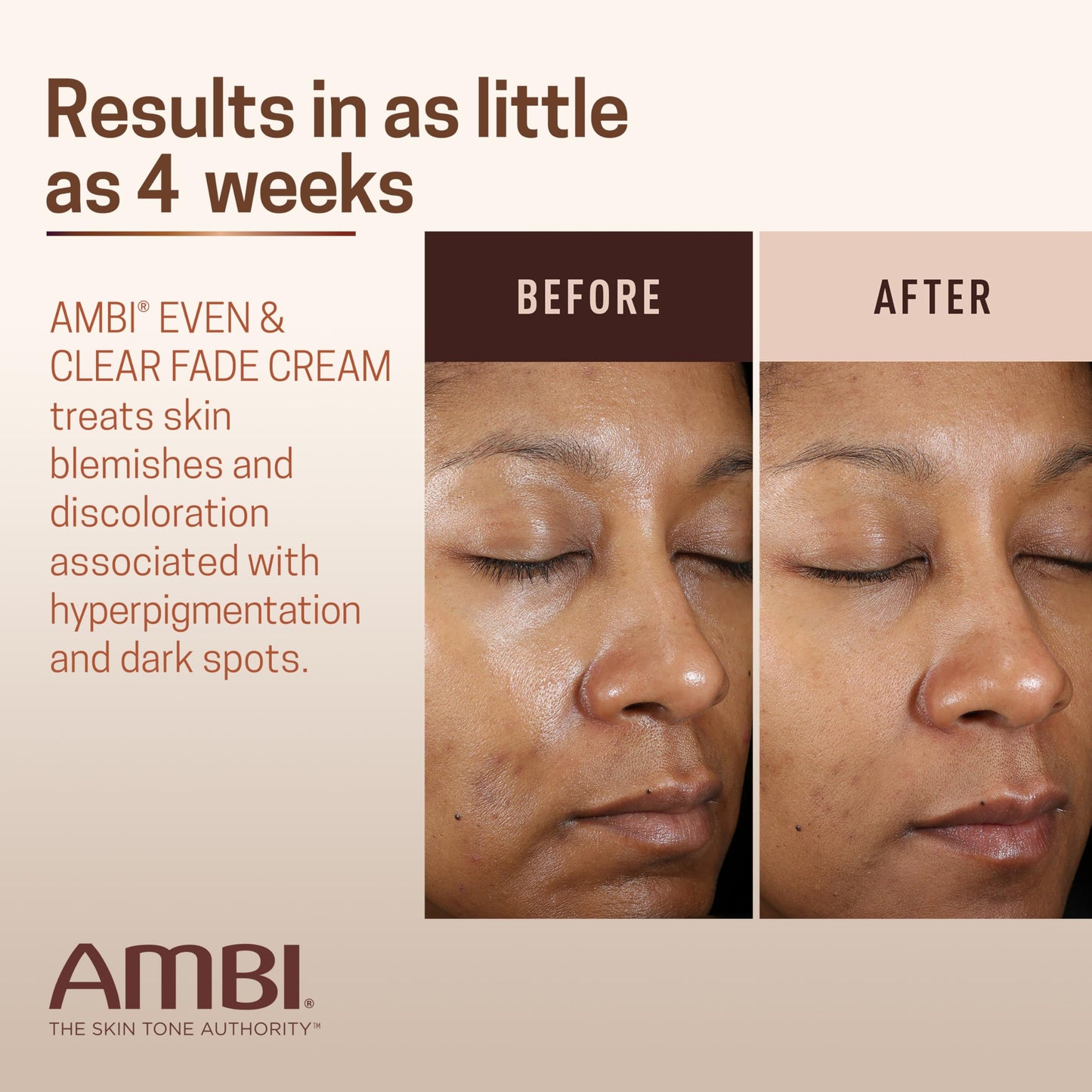 Ambi Even & Clear Fade Cream, Hydroquinone-free, Hyperpigmentation Treatment, Dark Spot Corrector, Results In As Little As 4 Weeks, Niacinamide, Aloe Beauty and Personal Care Ambi