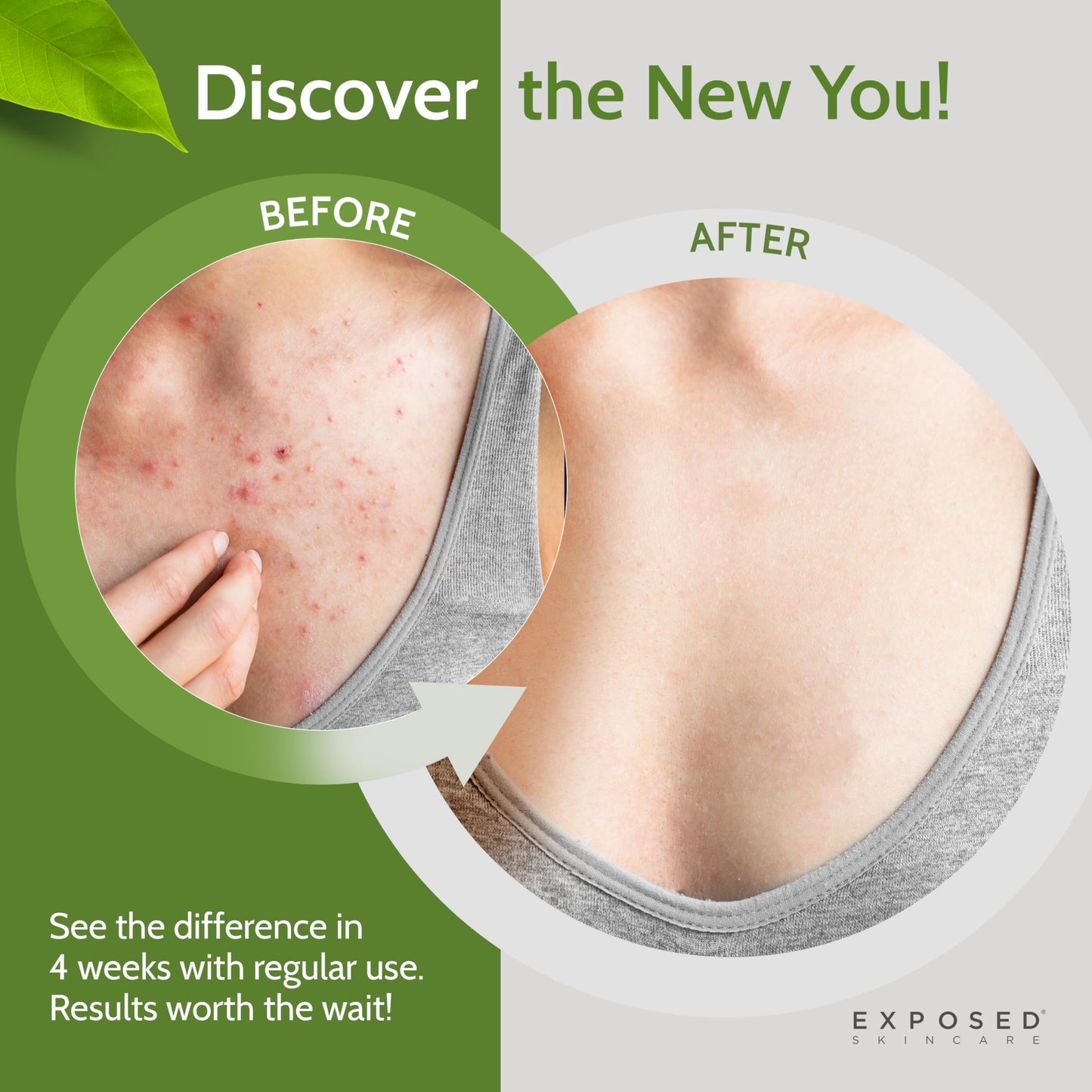 Exposed Skin Care, Body Acne Wash with Salicylic Acid, Glycolic Acid and Tea Tree Oil - Tri-Powered Gentle Exfoliating Cleanser for Back, Chest Beauty & Personal Care Exposed Skin Care