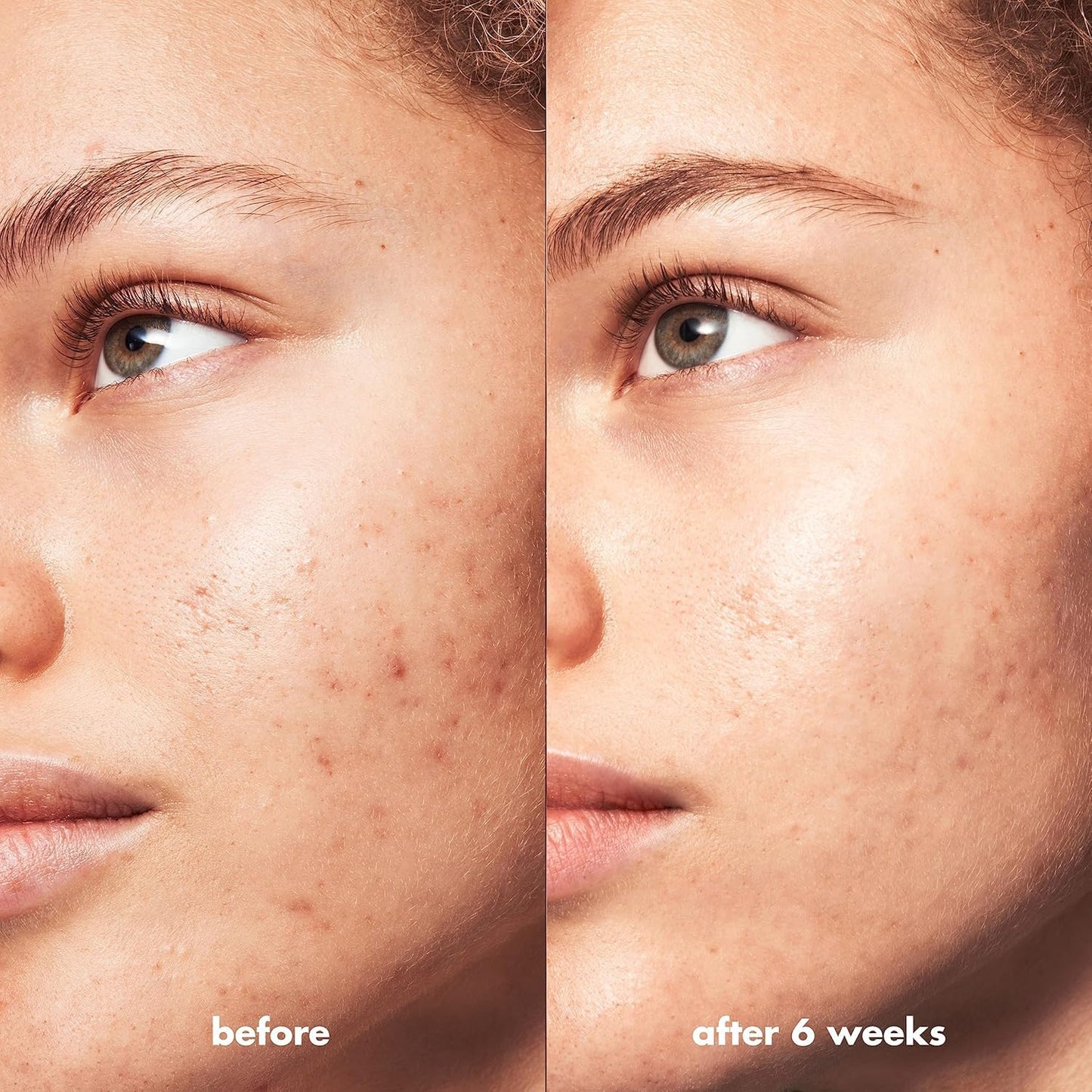 e.l.f. SKIN Blemish Breakthrough Triple-Acid Resurfacing Serum, Hydrating Night Serum For Fighting Blemishes, Helps Improve Skin Tone & Texture Beauty & Personal Care e.l.f.
