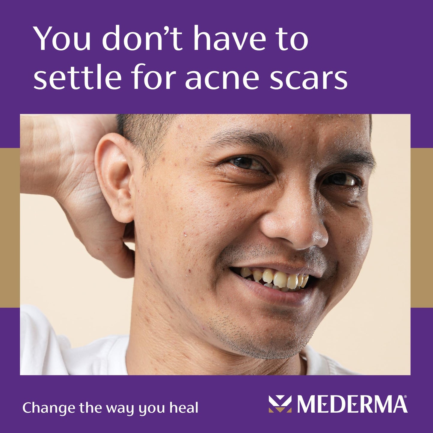 Mederma Acne Scar Serum Triple-Action Formula with Niacinamide, Tetrapeptide-30, and Polyhydroxy acid Clinically Shown to Lighten Acne Scars, 1 Fl Beauty & Personal Care Mederma