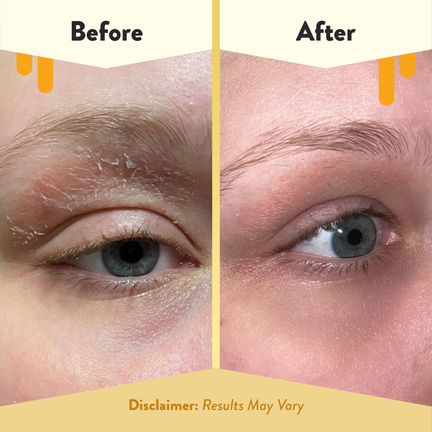 ECZEMA HONEY Multi Peptide Eye Cream - Anti Aging Eye Cream for Dark Circles & Puffiness - Facial Skin Care Products for Eczema, Dry & Sensitive Skin Beauty & Personal Care ECZEMA HONEY