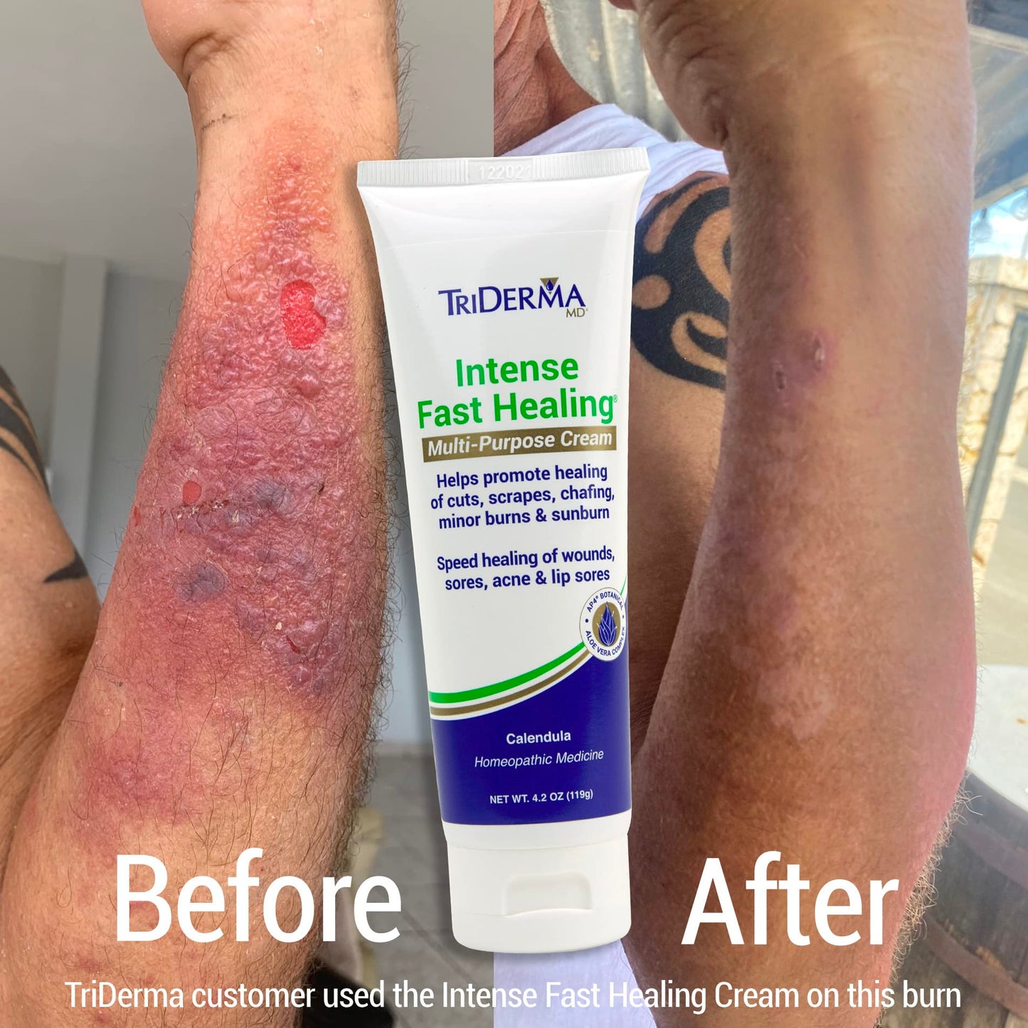 TriDerma Intense Fast Skin Healing Cream for Hard-to-Heal Skin Irritations, Sores, Rashes, Dry, Cracked Hands, Cuts, Chafing, Burns, Scrapes - First Beauty & Personal Care TriDerma