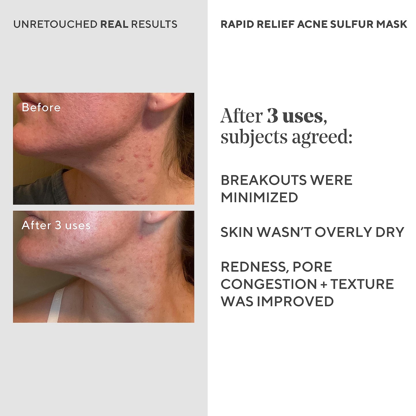 Murad Rapid Relief Acne Sulfur Mask - Clay Mask with Salicylic Acid, 5% Sulfur, and Austrian Peat Reduces Oil, Minimizes Breakouts, Reduces Pimple Beauty & Personal Care Murad