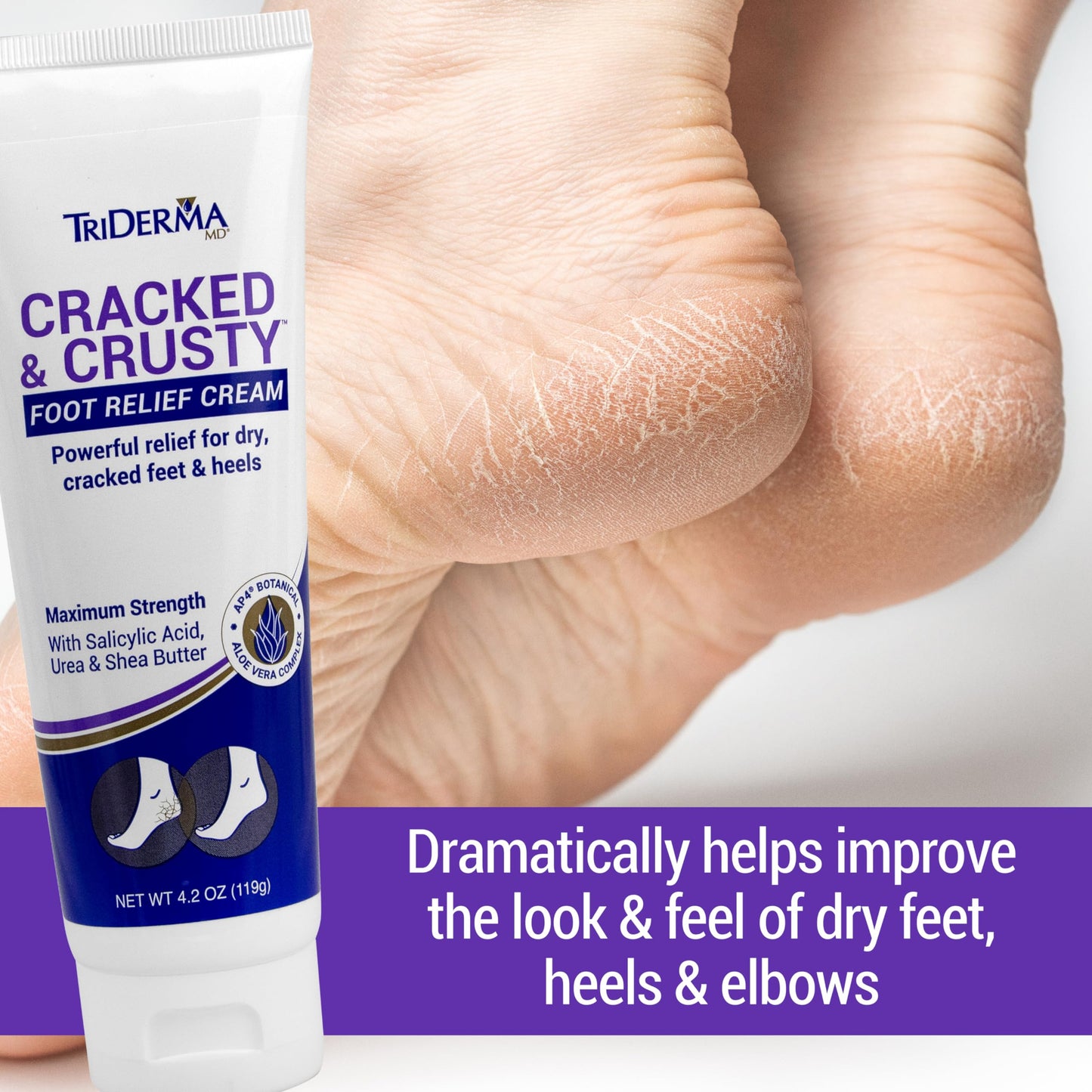 TriDerma Cracked & Crusty™ Healthy Foot Cream Moisturizes, Softens and Heals Dry Feet, Cracked Heels and Dry Elbows with Salicylic Acid, Urea, Shea Beauty & Personal Care TriDerma