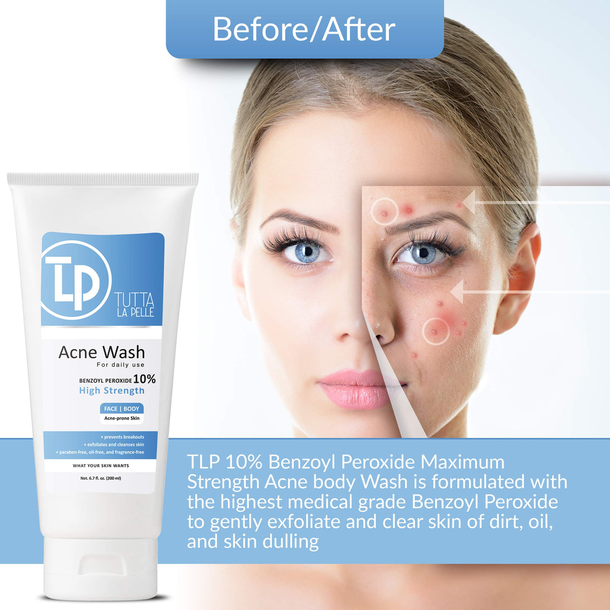 Tutta La Pelle Benzoyl Peroxide Body Wash 10% - Acne Face Wash & Acne Body Wash - Butt Acne Treatment & Back Acne Treatment - Highest Grade Medical Beauty & Personal Care Tutta La Pelle